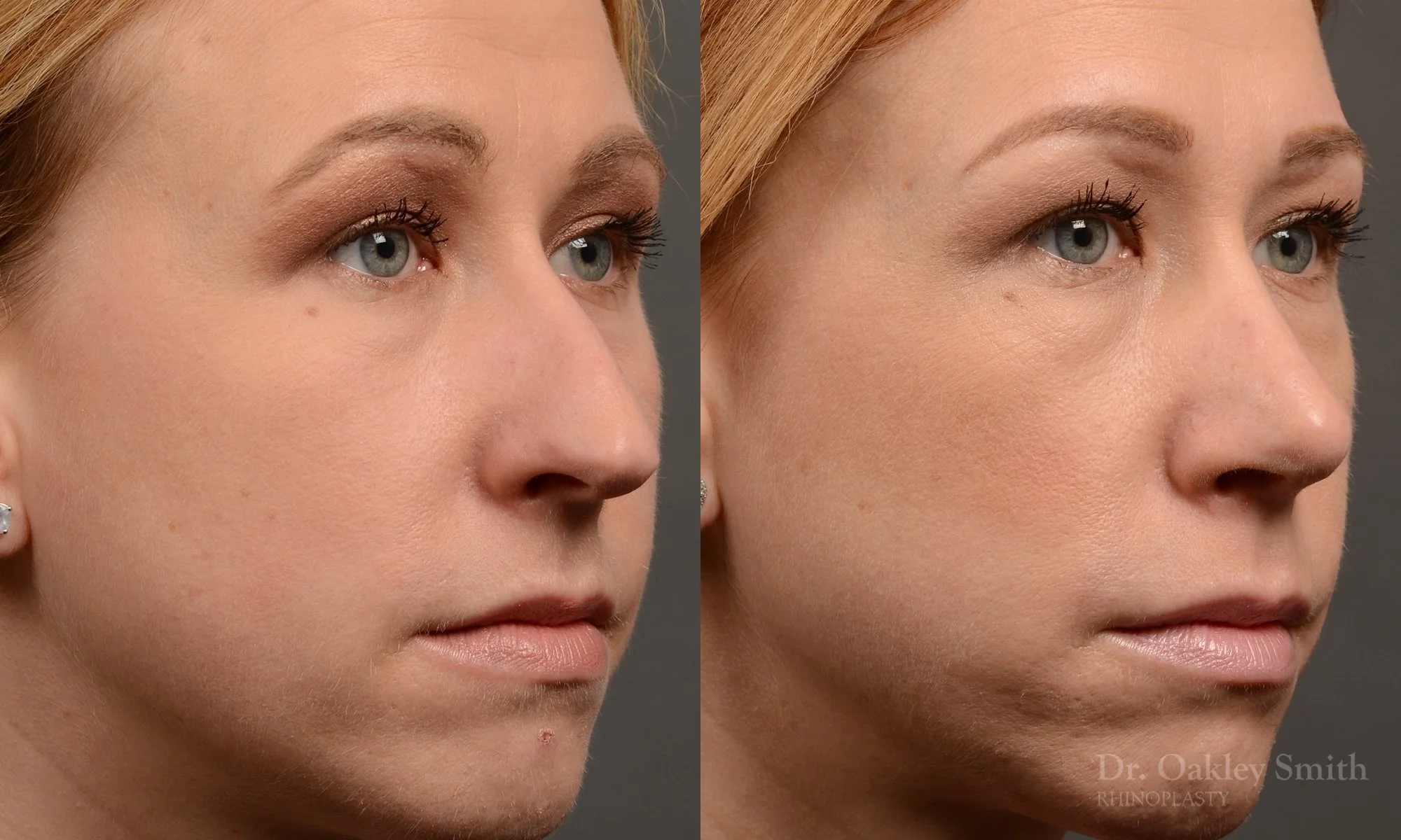 363.2B-rhinoplasty-dr-oakley-smith-toronto-nose-job.jpg