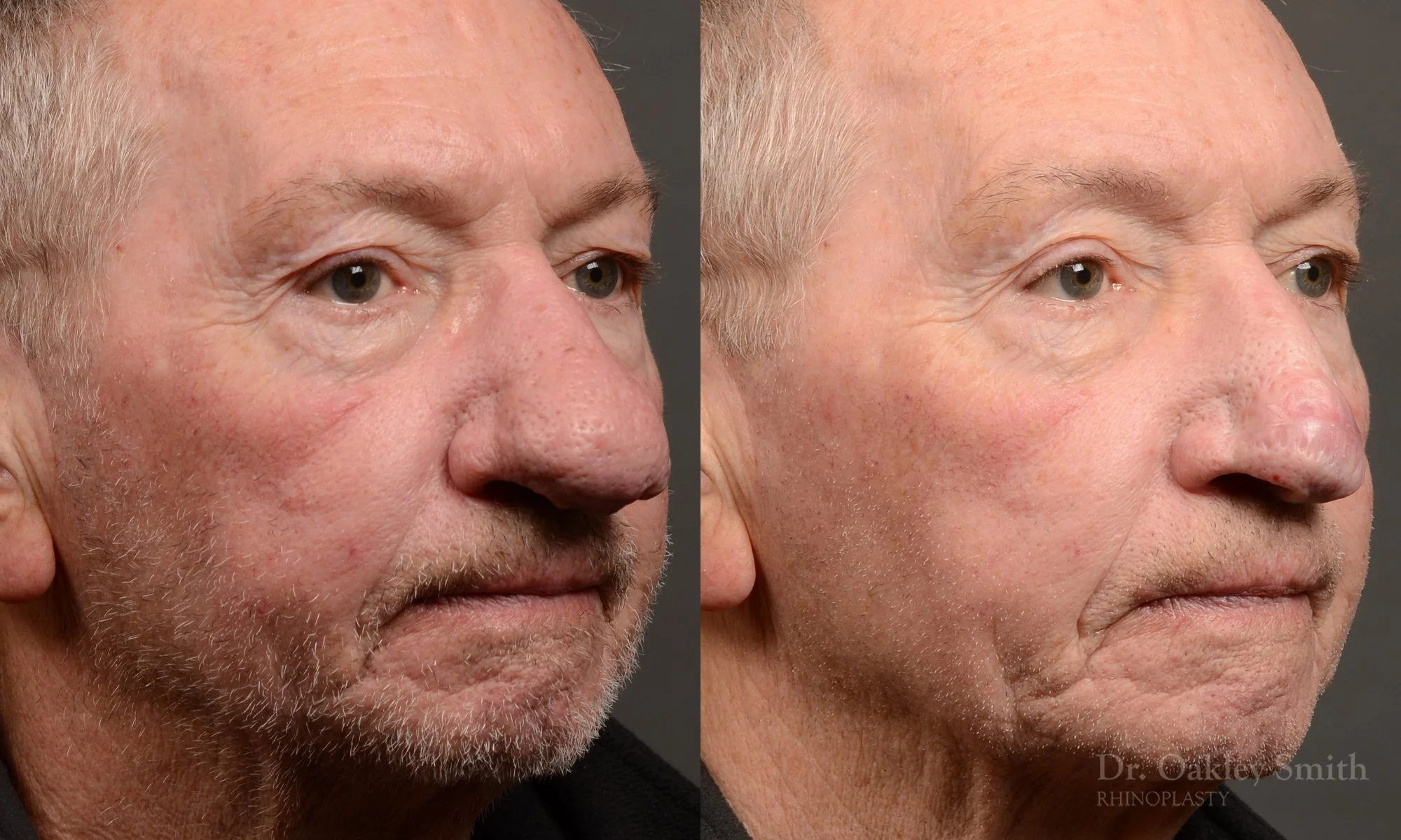 Case 548 dr oakley smith, male rhinophyma, 12 months after surgery, right oblique view.jpg