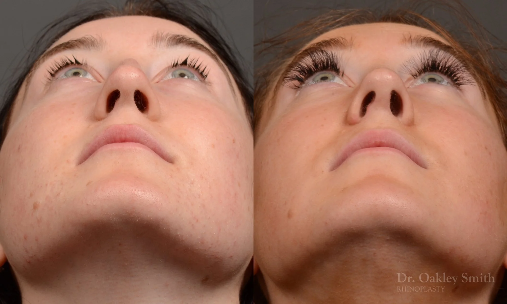 484F-rhinoplasty-dr-oakley-smith-toronto-top-surgeon-nose-job.jpg