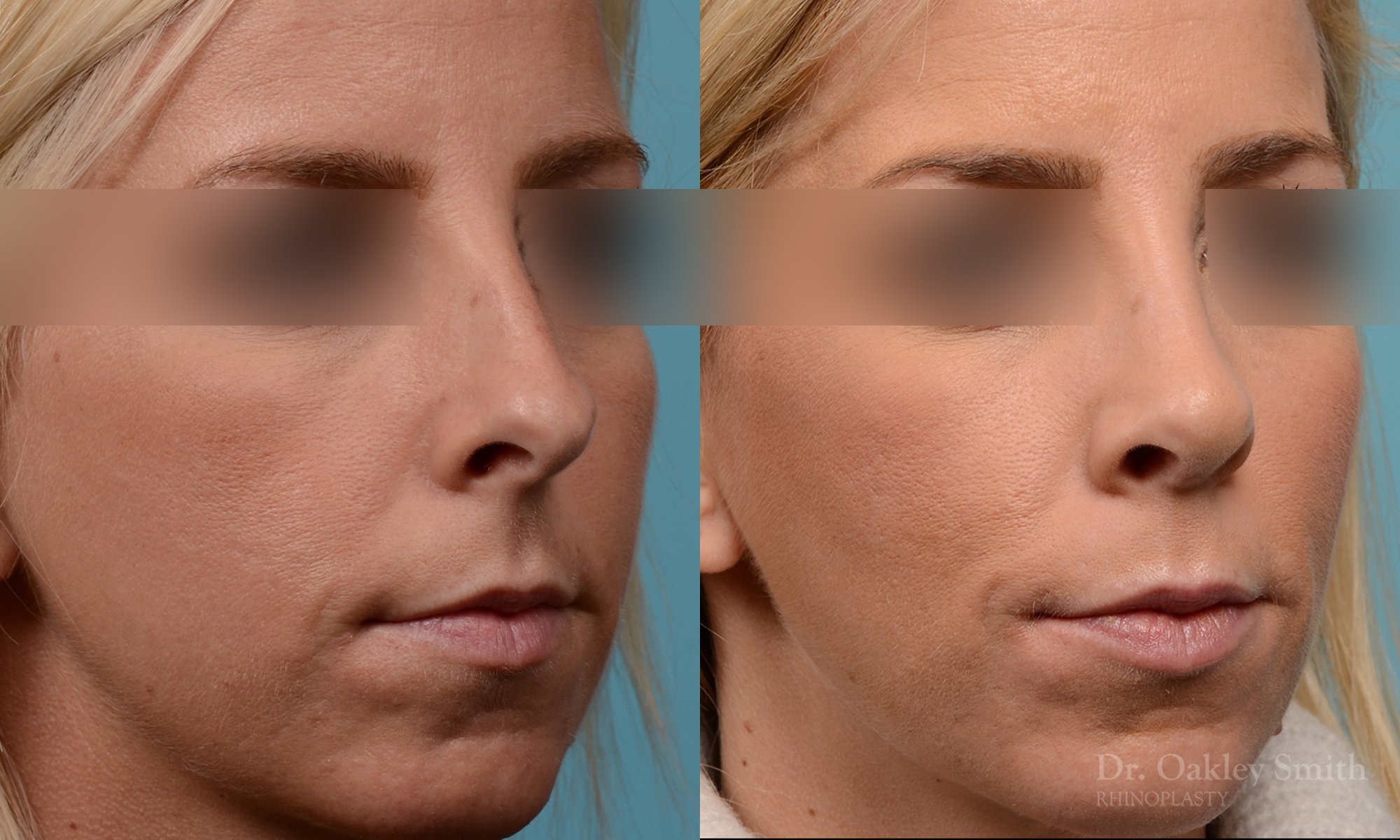 242B-rhinoplasty-dr-oakley-smith-toronto-nose-job-2.jpg