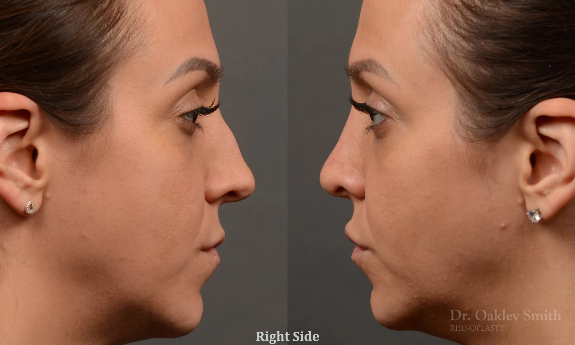 353C-rhinoplasty-dr-oakley-smith-toronto-nose-job.jpg