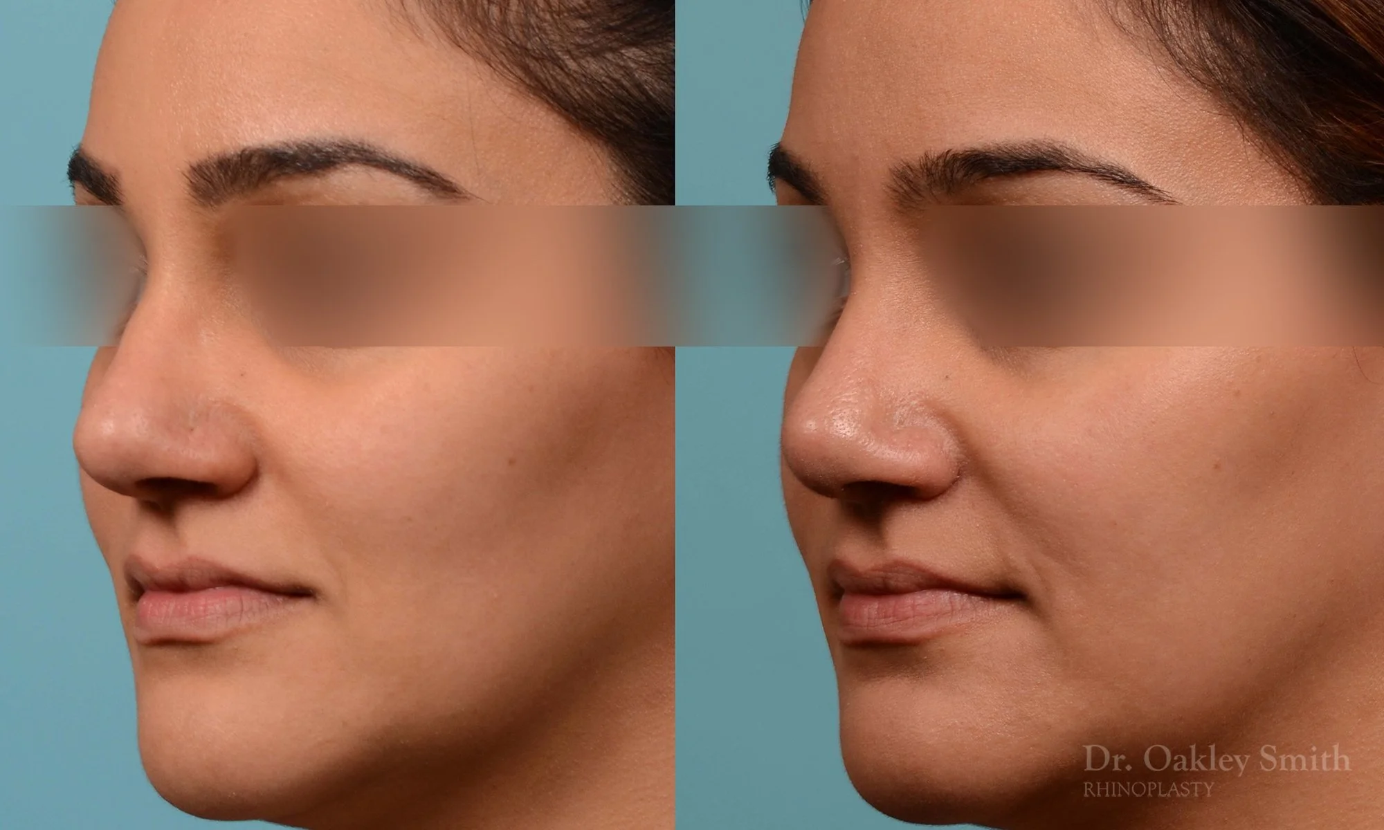 223D-nose-job-long-nose-rhinoplasty-dr-oakley-smith-curved-nose-wide-base-of-nose-projected-tip-weir-incisions-1-1.jpg