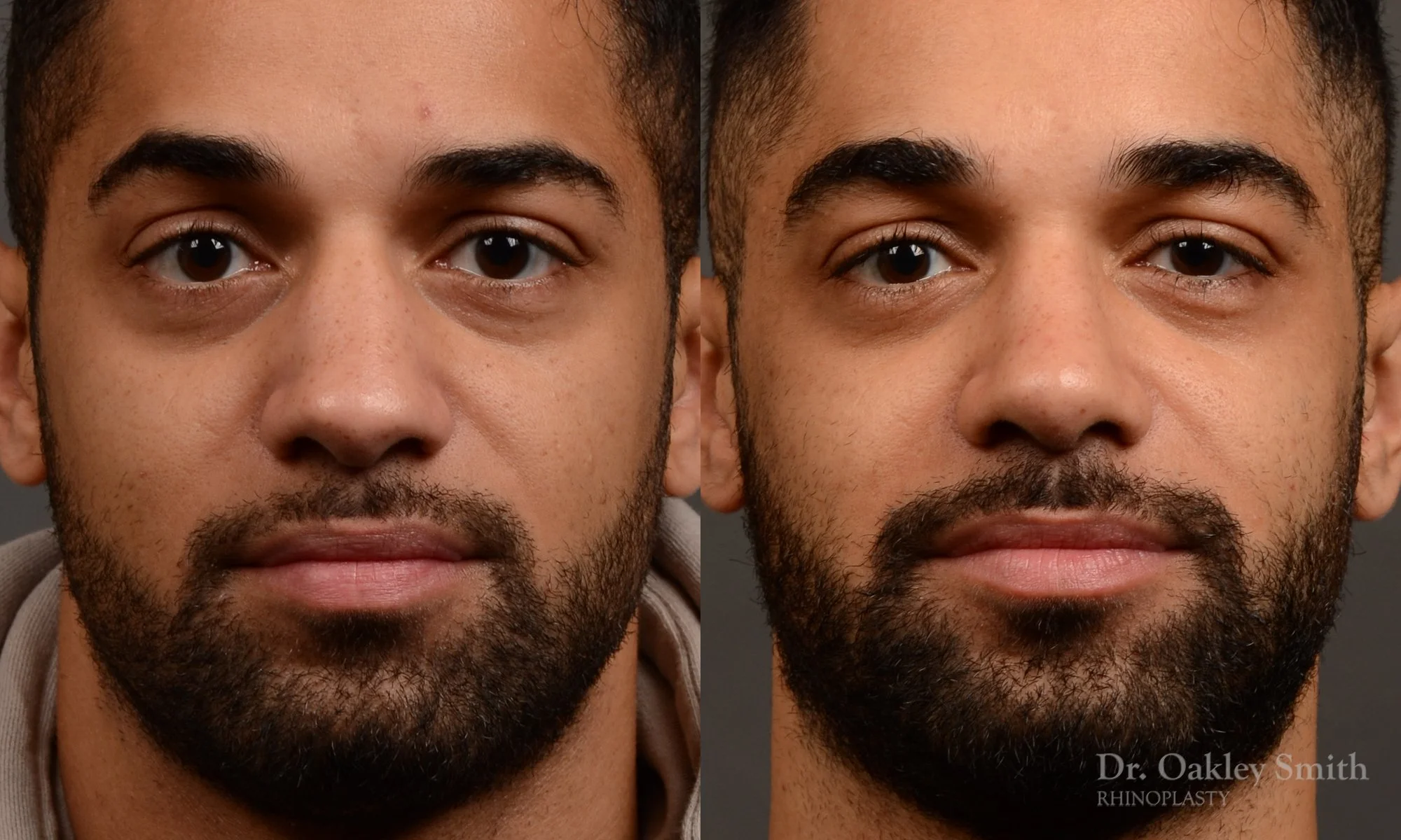 544A-male-rhinoplasty-before-and-after-nose-job-toronto-Dr.-Oakley-Smith.jpg