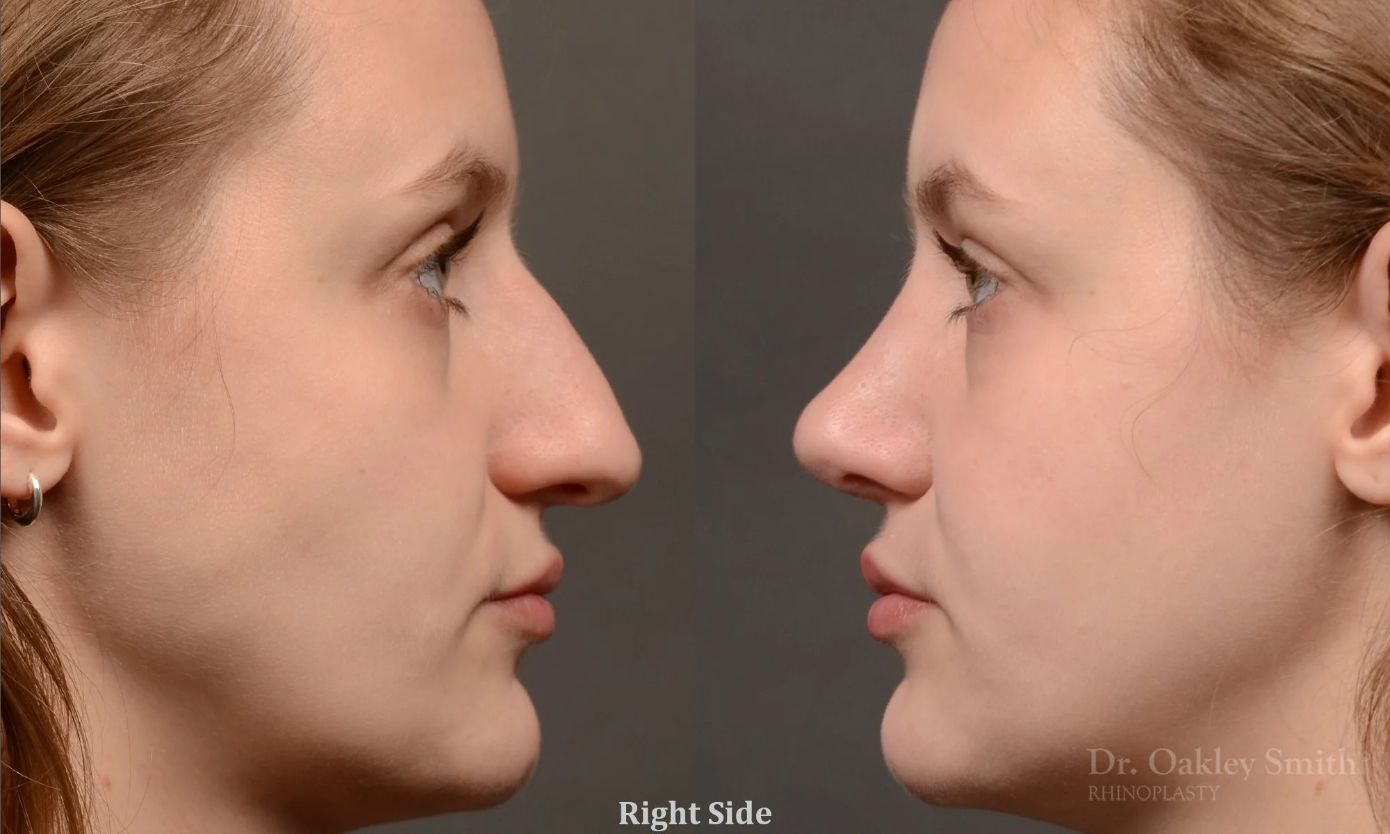 539C-rhinoplasty-dr-oakley-smith-toronto-nose-job.jpg