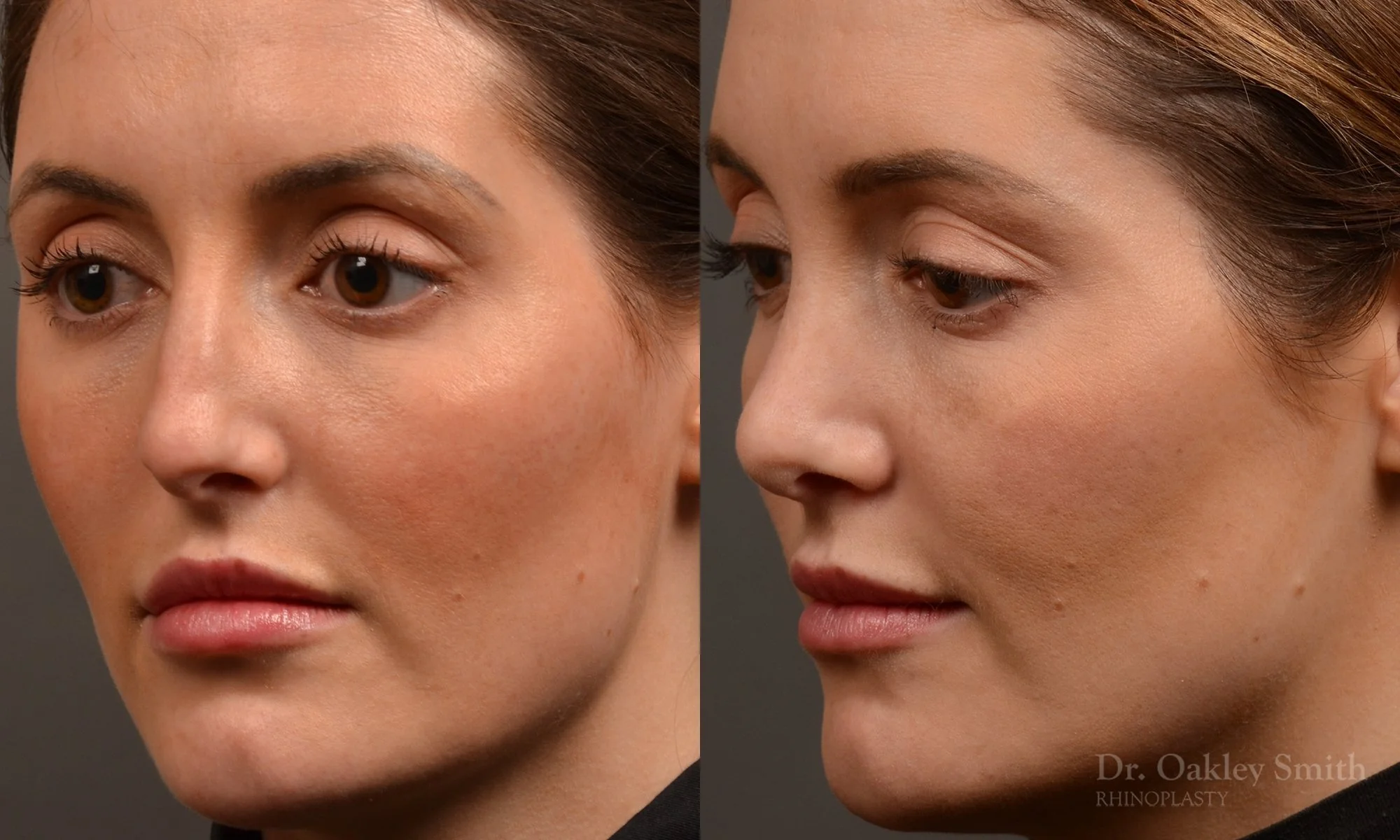490D-rhinoplasty-dr-oakley-smith-toronto-top-surgeon-nose-job.jpg