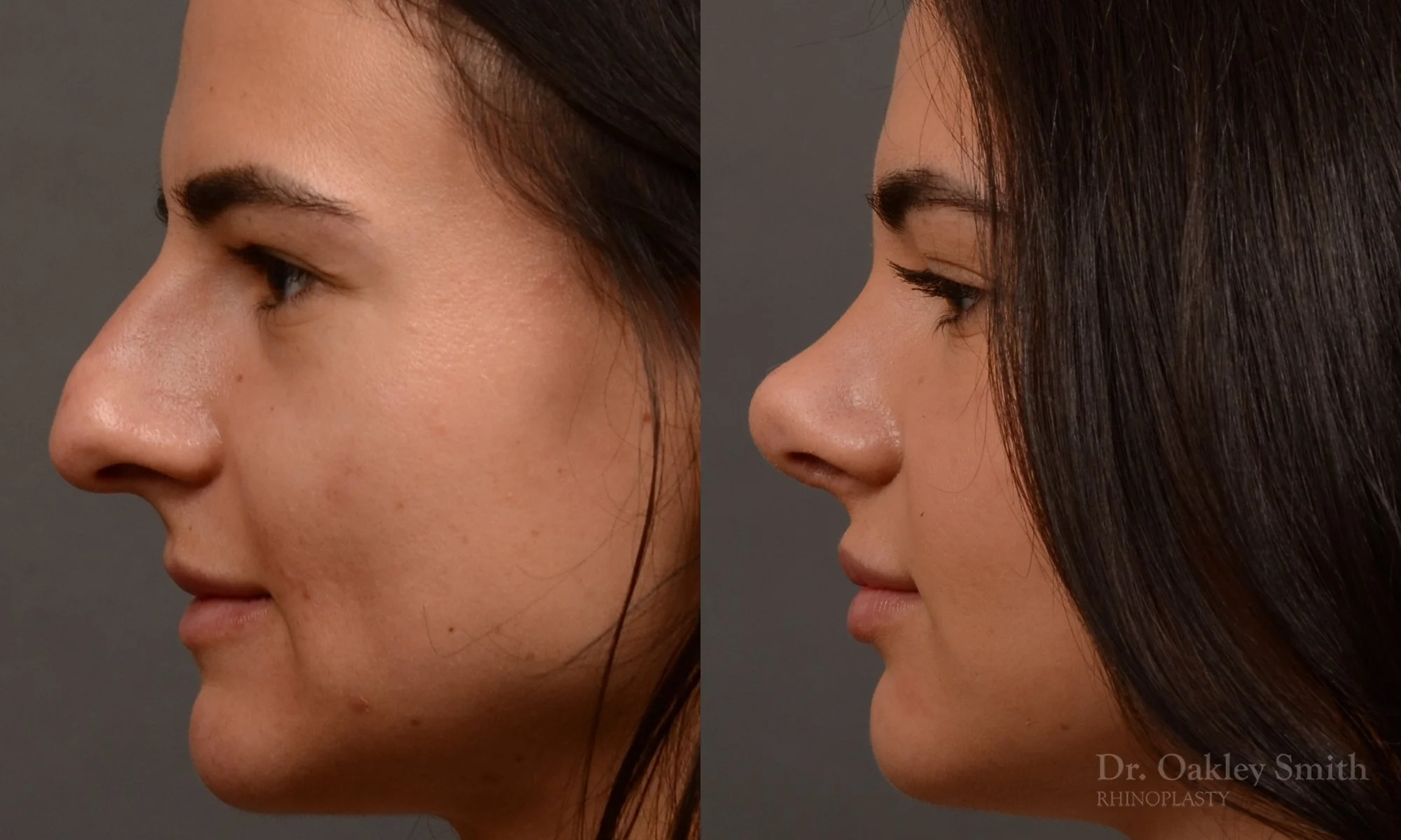 509E-rhinoplasty-dr-oakley-smith-toronto-top-surgeon-nose-job.jpg