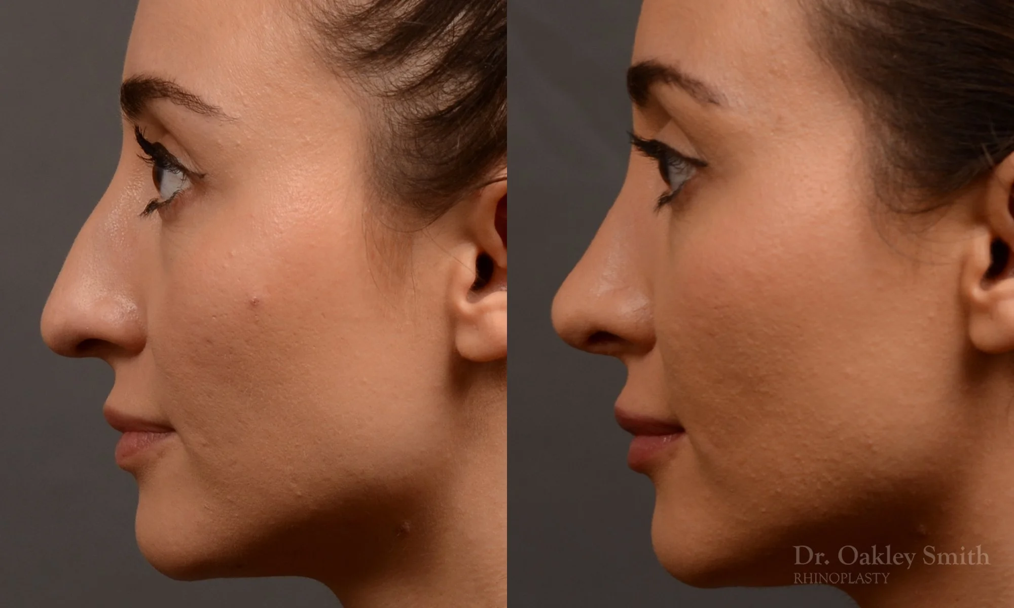 522E-rhinoplasty-dr-oakley-smith-toronto-top-surgeon-nose-job.jpg