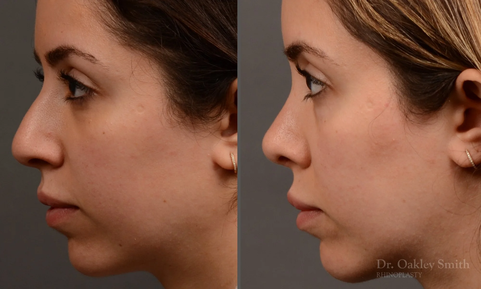 507E-rhinoplasty-dr-oakley-smith-toronto-top-surgeon-nose-job.jpg