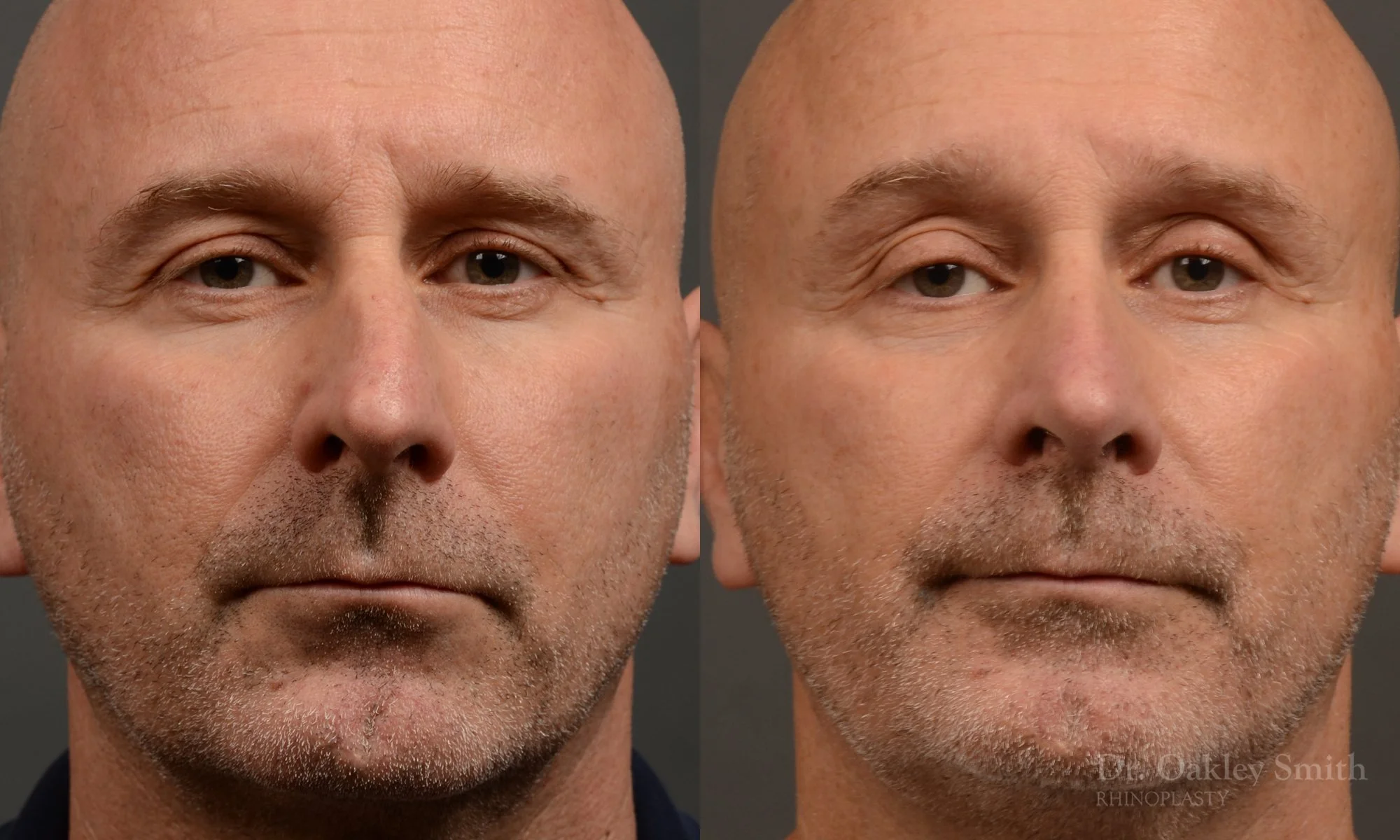 493A-male-rhinoplasty-dr-oakley-smith-toronto-top-surgeon-nose-job.jpg