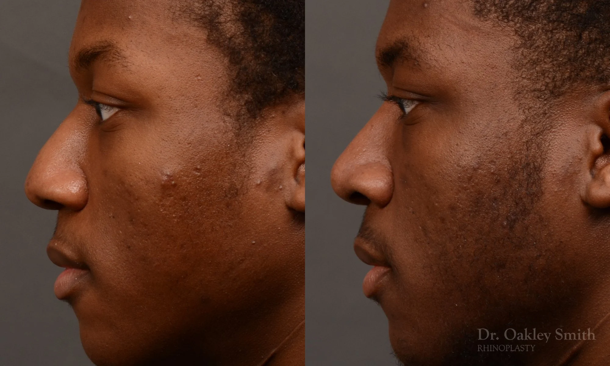 515E-male-rhinoplasty-dr-oakley-smith-toronto-top-surgeon-nose-job.jpg