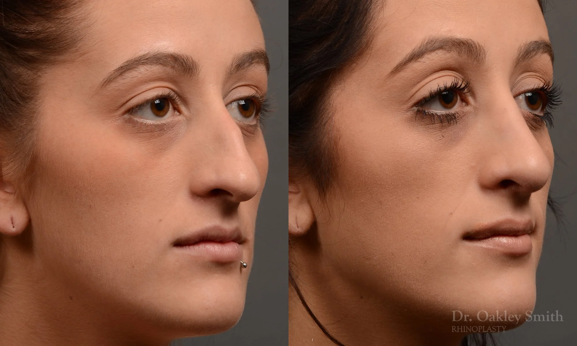 316B-rhinoplasty-dr-oakley-smith-toronto-nose-job.jpg