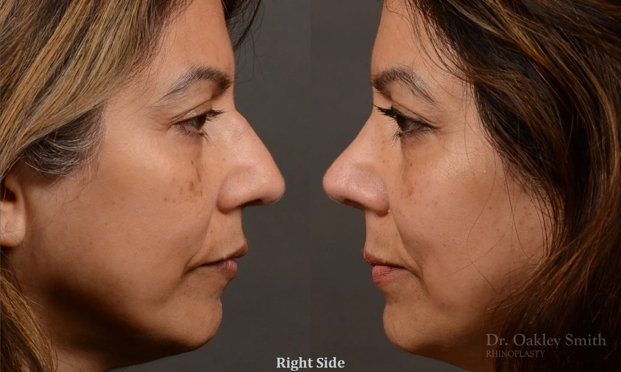 500C-rhinoplasty-dr-oakley-smith-toronto-top-surgeon-nose-job.jpg