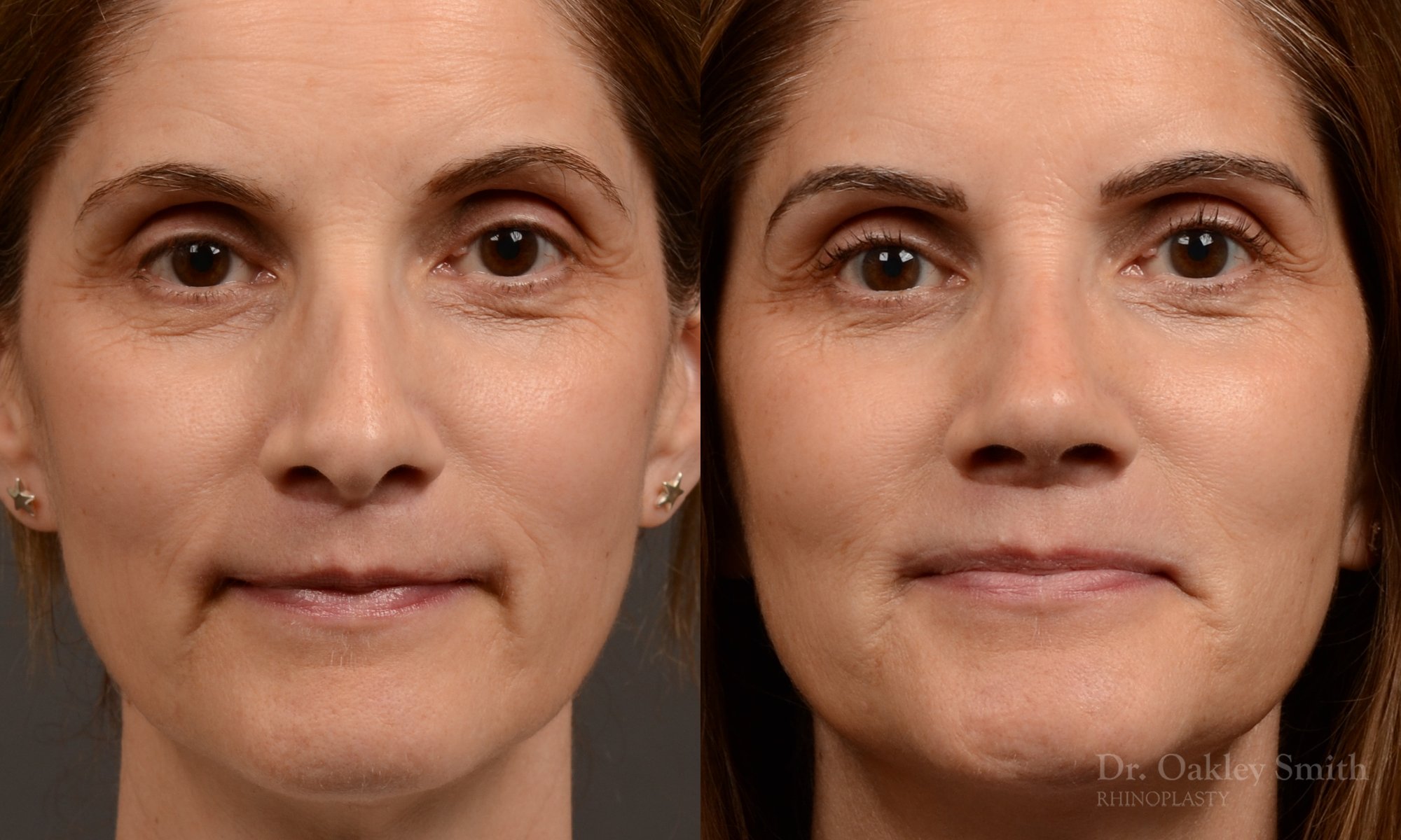 546A-rhinoplasty-nose-job-top-toronto-surgeon-dr-oakley-smith.jpg
