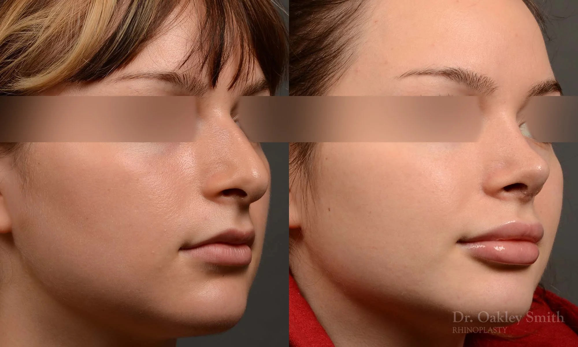530B-rhinoplasty-dr-oakley-smith-toronto-top-surgeon-nose-job.jpg