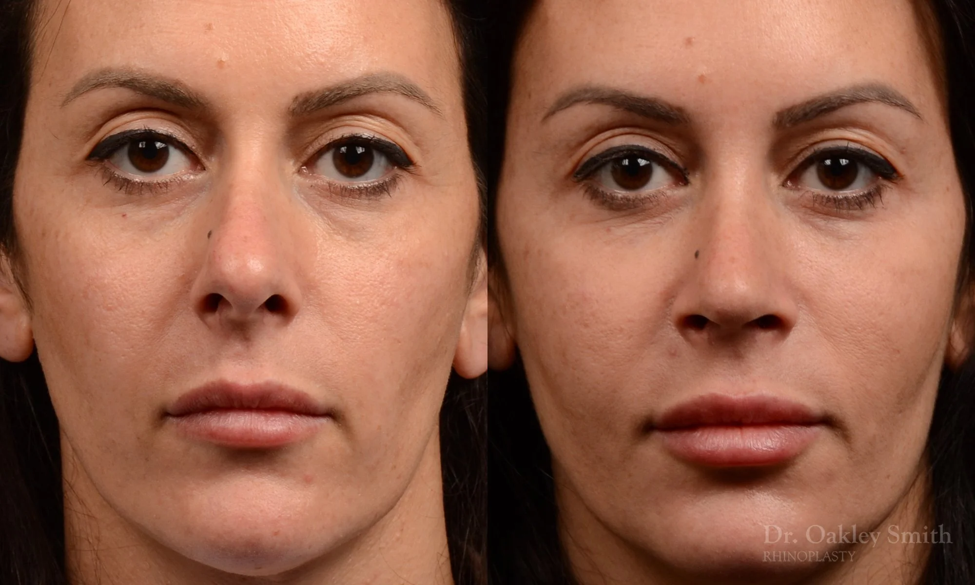 495A-rhinoplasty-dr-oakley-smith-toronto-top-surgeon-nose-job.jpg