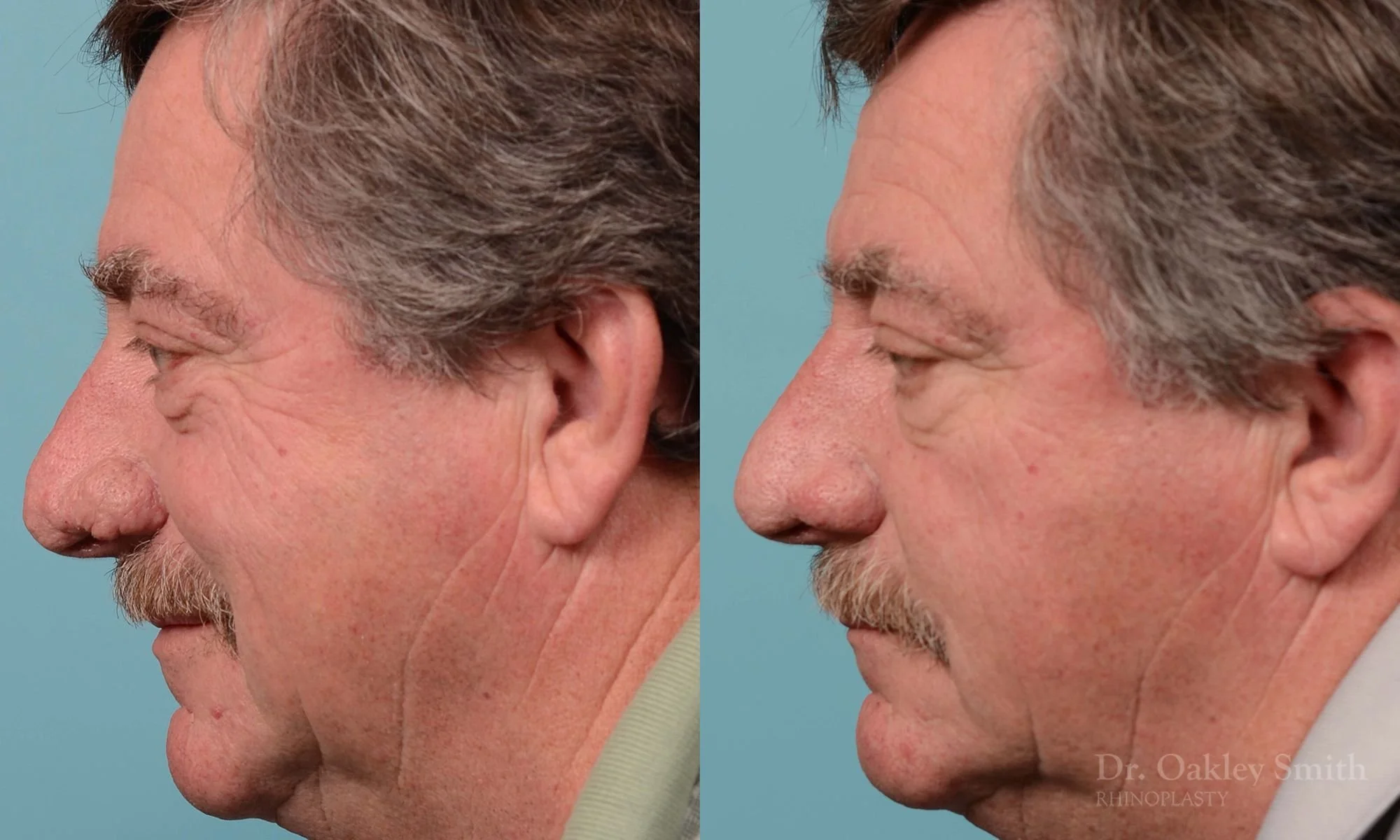 210E-rhinoplasty-rhinophyma-elderly-man-dr-oakley-smith-toronto-nose-reduction-1.jpg