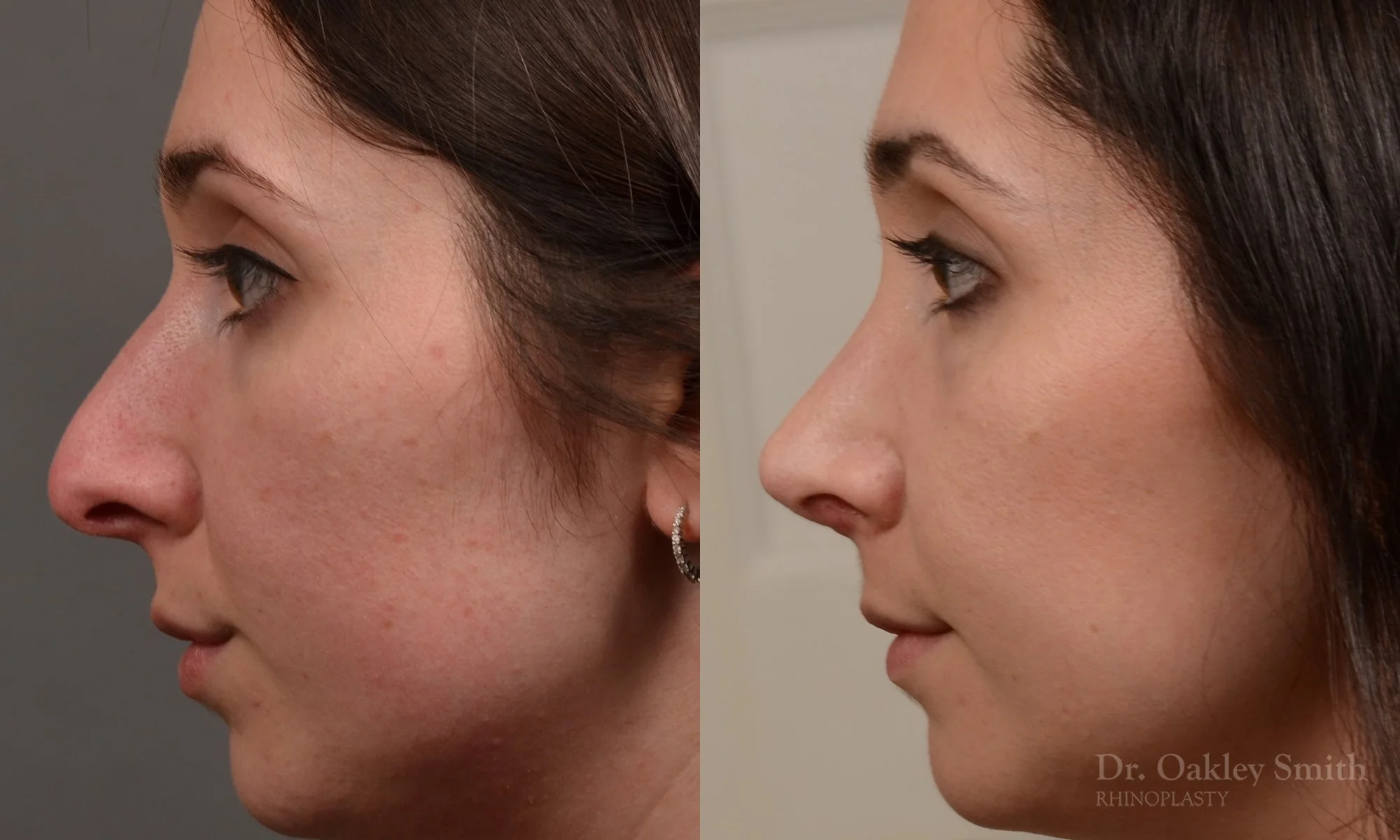 476E-rhinoplasty-dr-oakley-smith-toronto-top-surgeon-nose-job.jpg