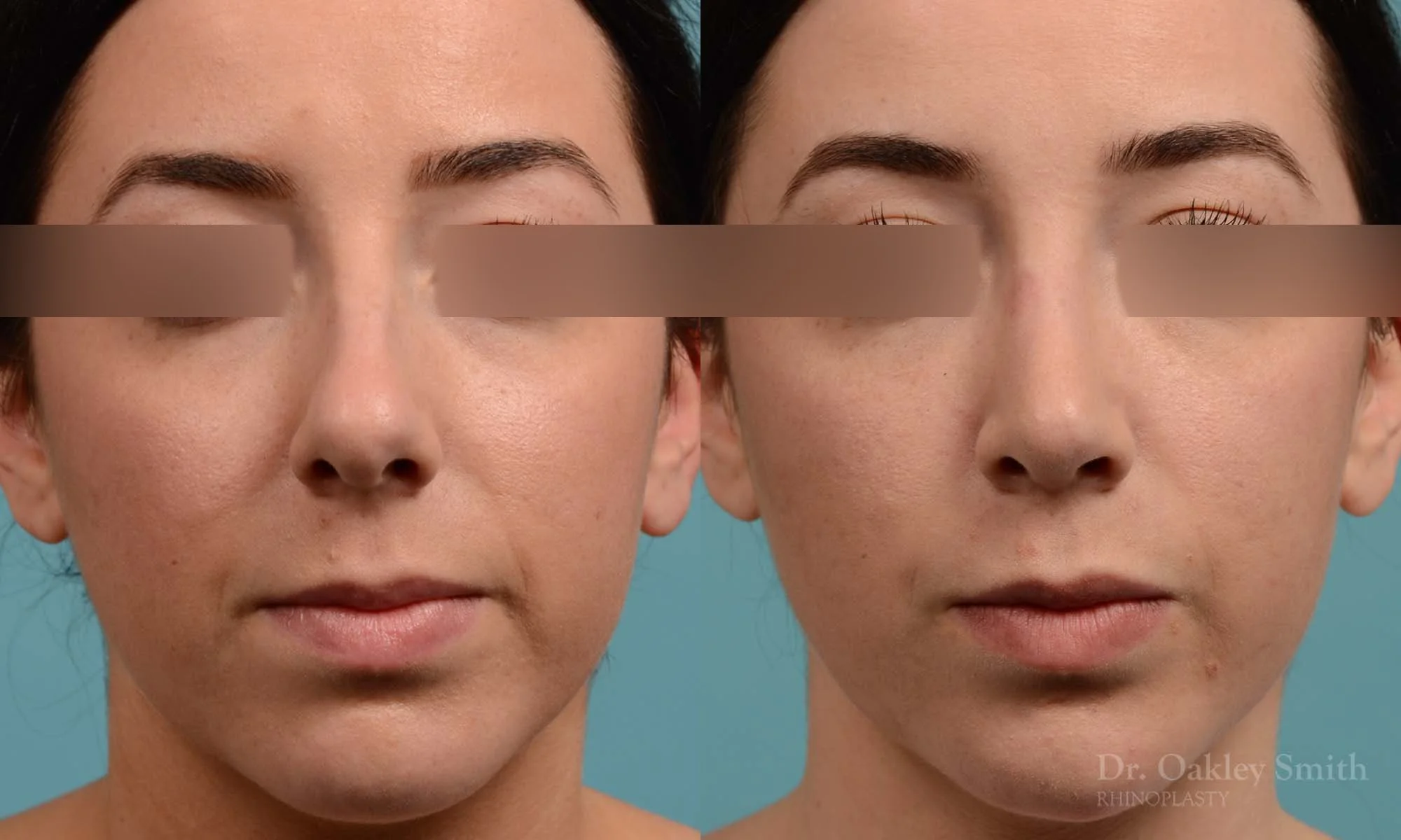 283A-rhinoplasty-dr-oakley-smith-toronto-nose-job-1 (1).jpg