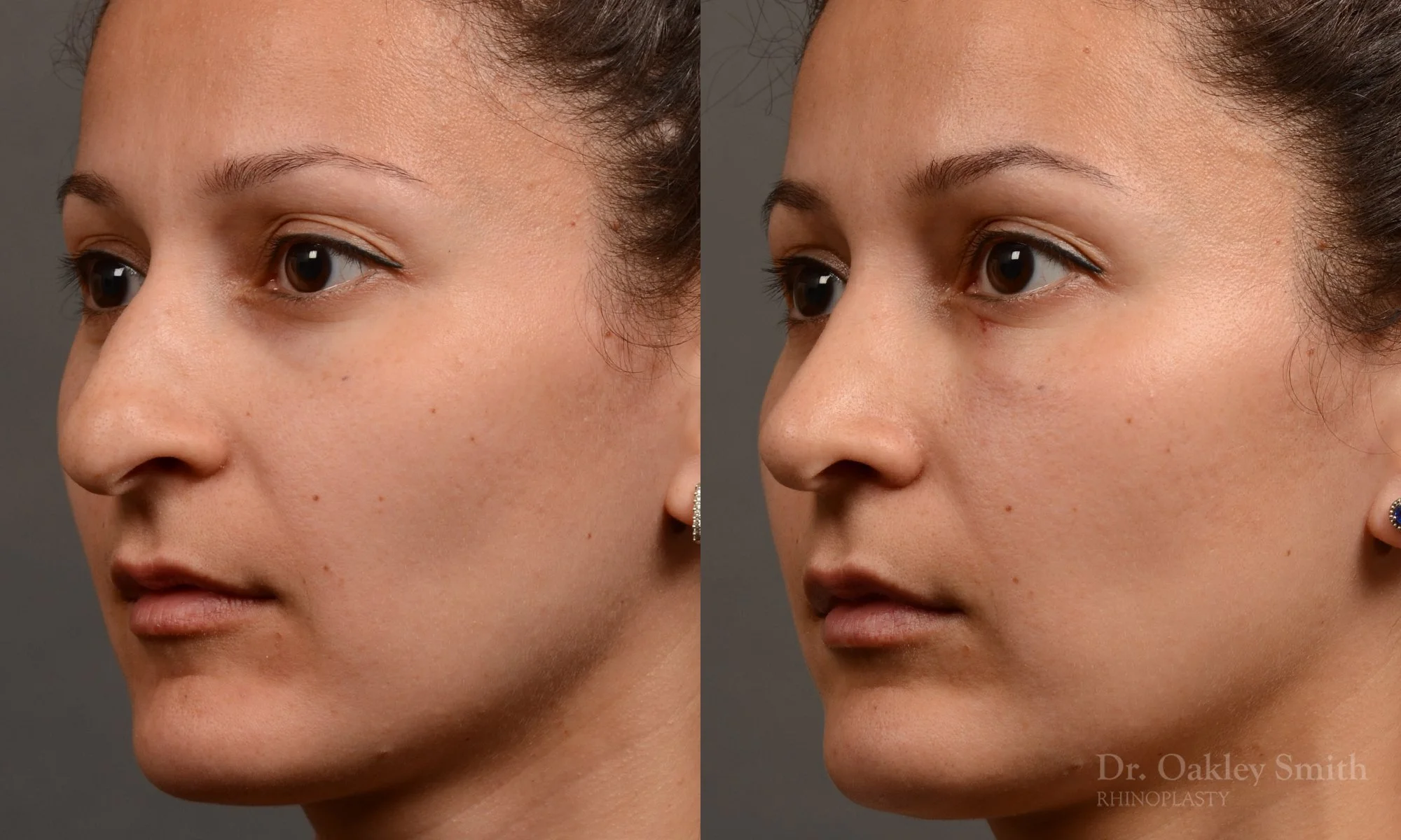 332D-rhinoplasty-dr-oakley-smith-toronto-nose-job (1).jpg