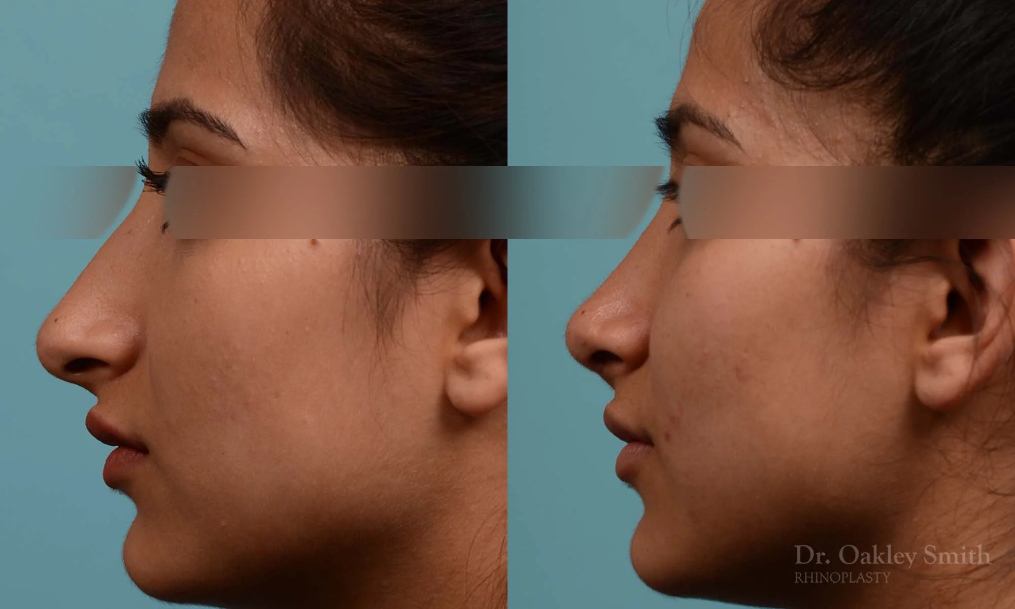 308E-rhinoplasty-dr-oakley-smithm-toronto-nose-job.jpg