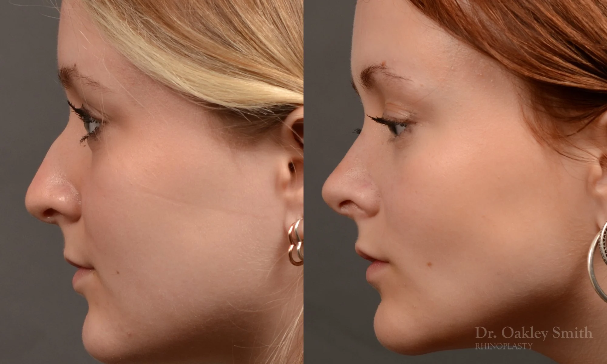 475E-rhinoplasty-dr-oakley-smith-toronto-top-surgeon-nose-job.jpg