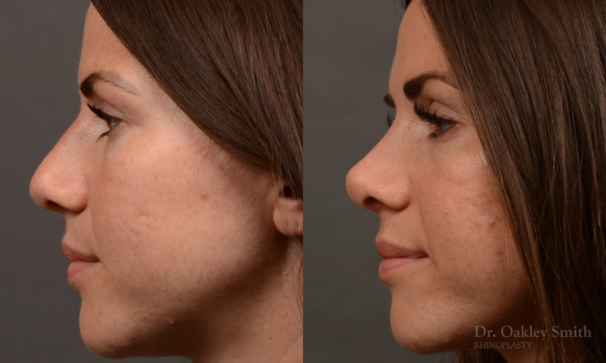 481E-rhinoplasty-dr-oakley-smith-toronto-top-surgeon-nose-job.jpg
