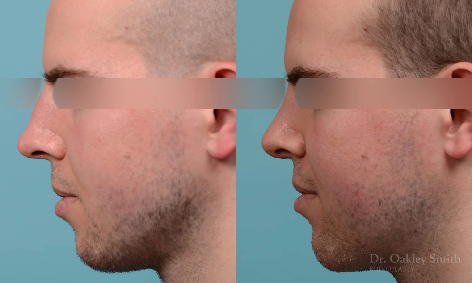 278E-rhinoplasty-dr-oakley-smith-toronto-male-nose-job.jpg