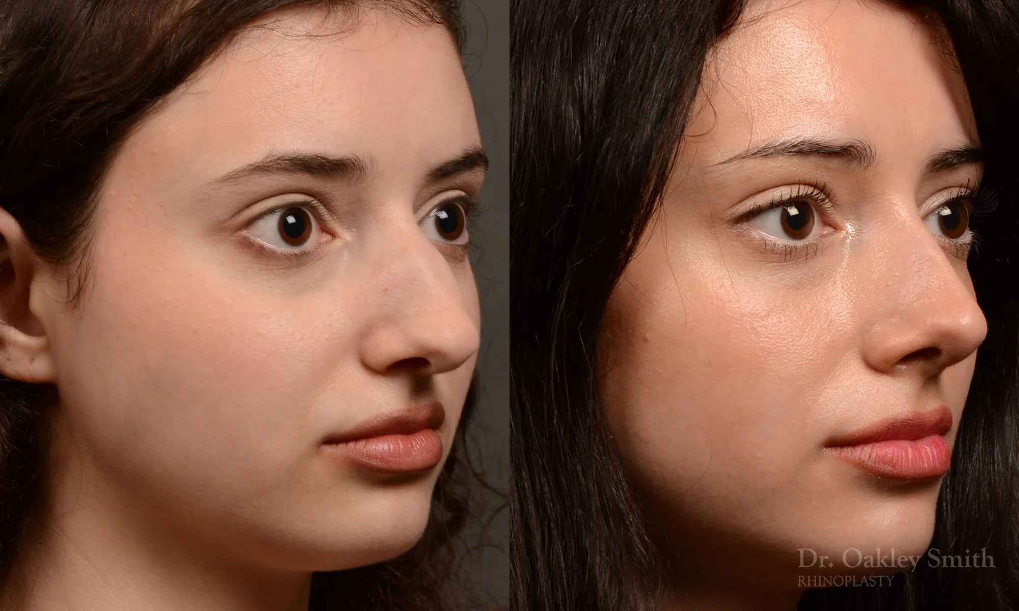 547B-rhinoplasty-dr.-oakley-smith-top-rhino-surgeon-toronto.jpg