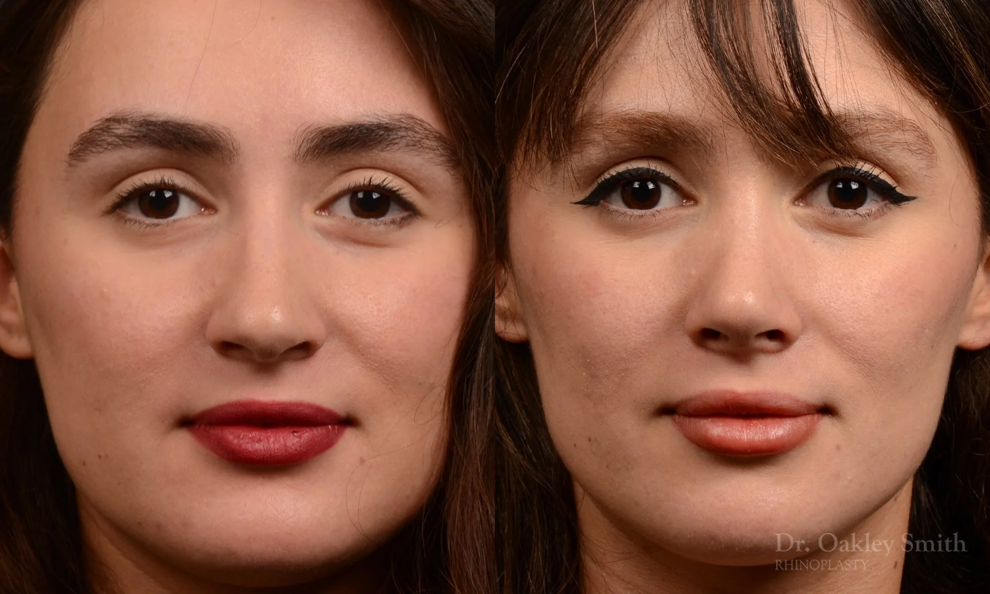 526A-rhinoplasty-dr-oakley-smith-toronto-top-surgeon-nose-job.jpg