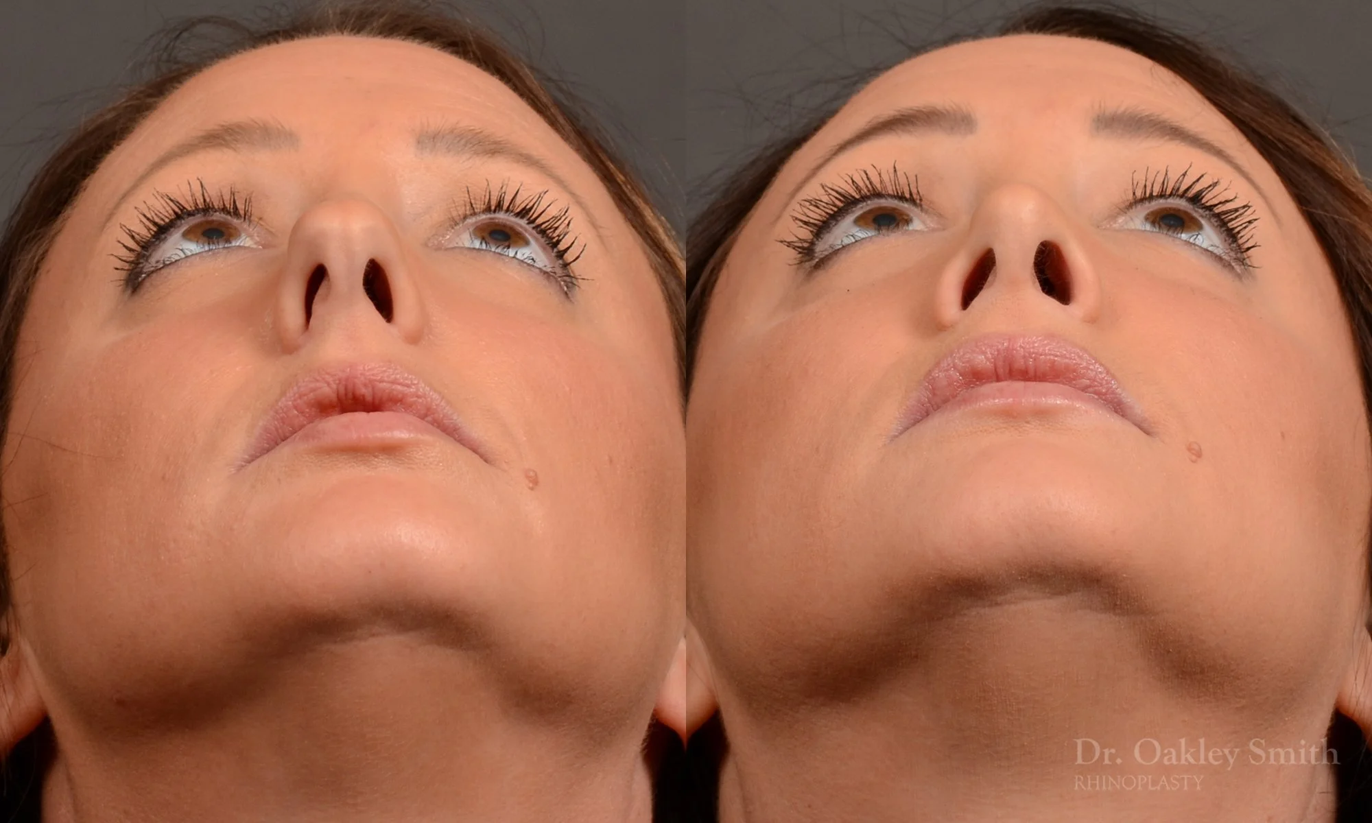 499F-rhinoplasty-dr-oakley-smith-toronto-top-surgeon-nose-job.jpg