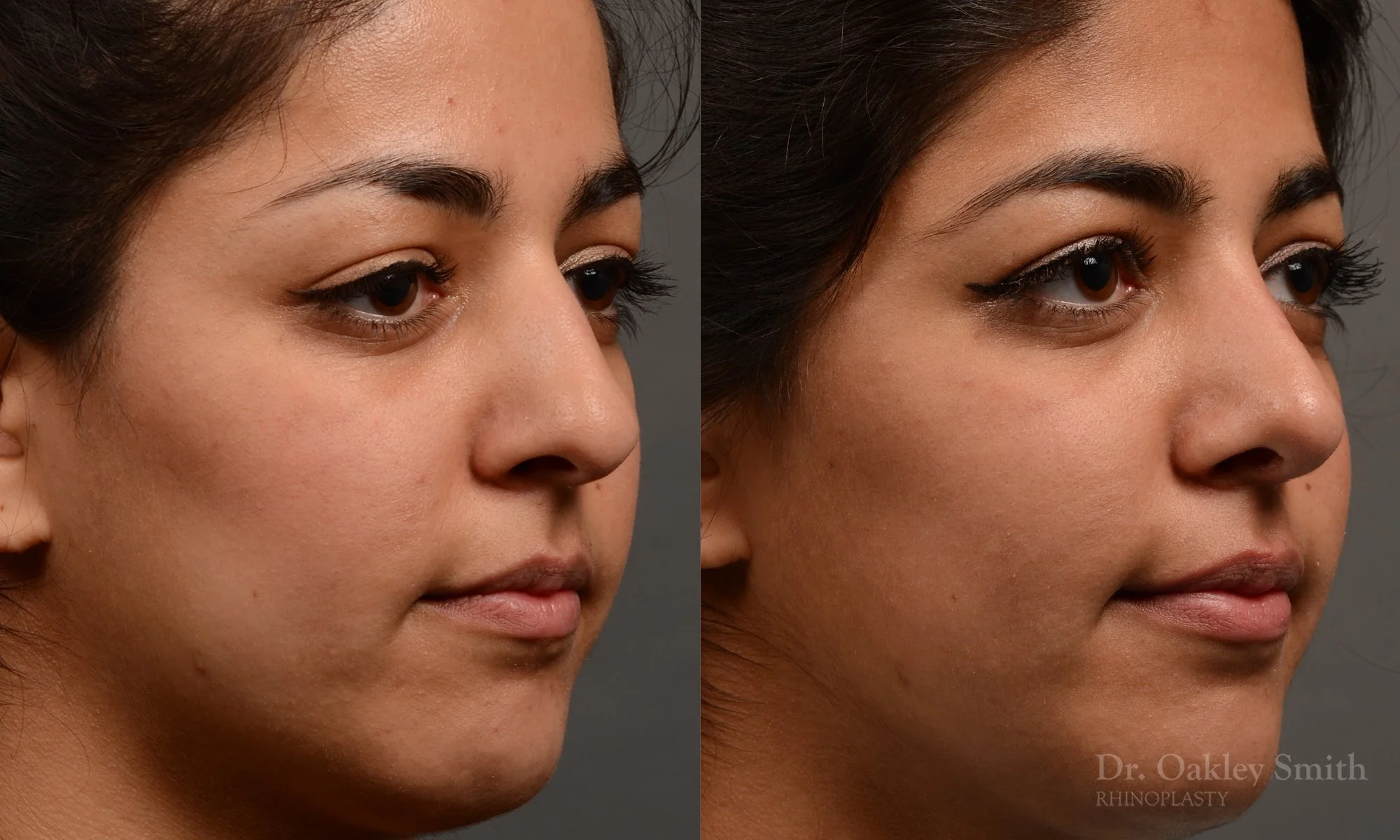 296.5B-rhinoplastydr-oakley-smith-toronto-nose-job.jpg