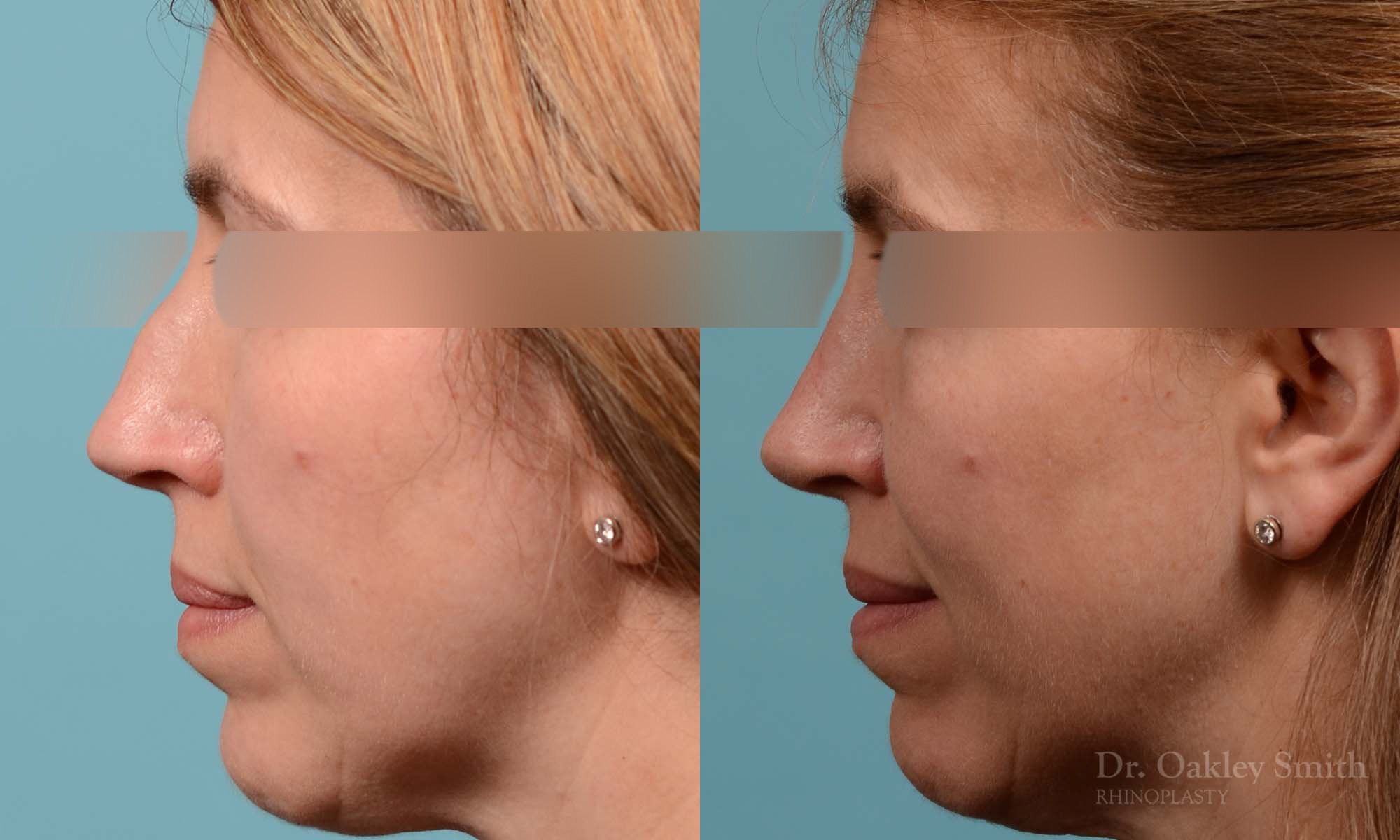291E-rhinoplasty-dr-oakley-smith-toronto-nose-job.jpg