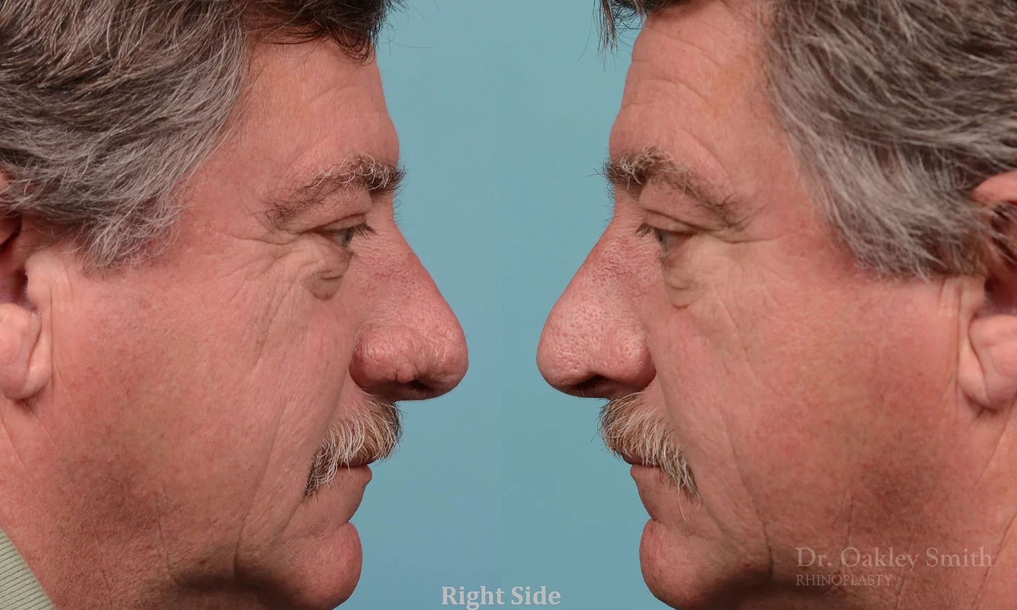 210C-rhinoplasty-rhinophyma-elderly-man-dr-oakley-smith-toronto-nose-reduction-1.jpg