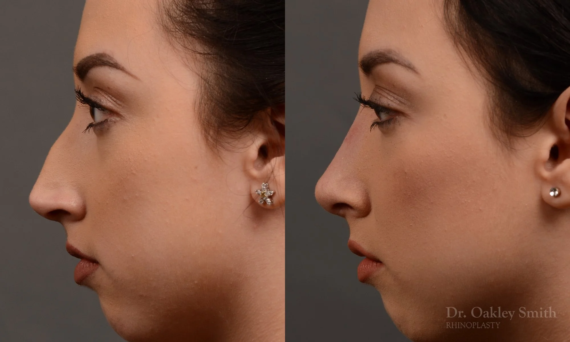 340.1E-rhinoplasty-dr-oakley-smith-toronto-nose-job.jpg