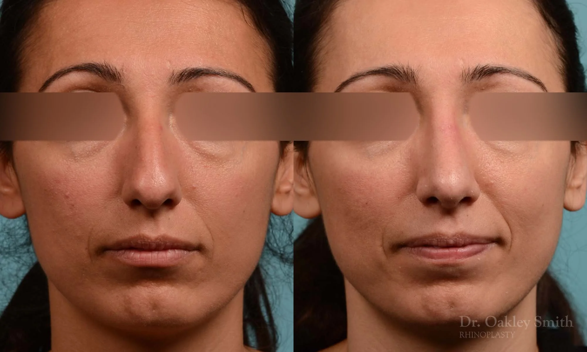 273A-rhinoplasty-dr-oakley-smith-toronto-nose-job.jpg