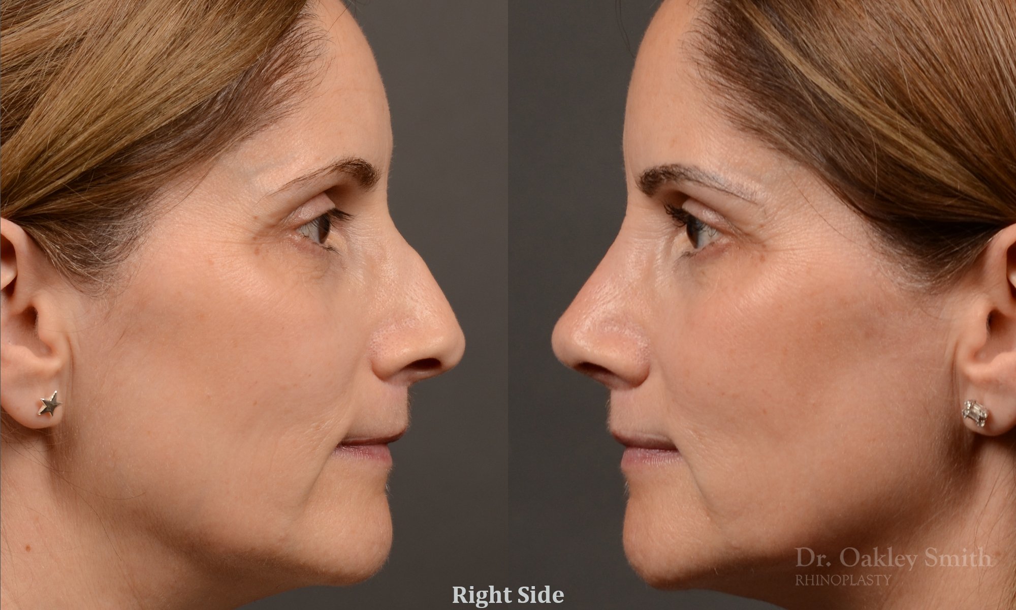 546C-rhinoplasty-nose-job-top-toronto-surgeon-dr-oakley-smith.jpg