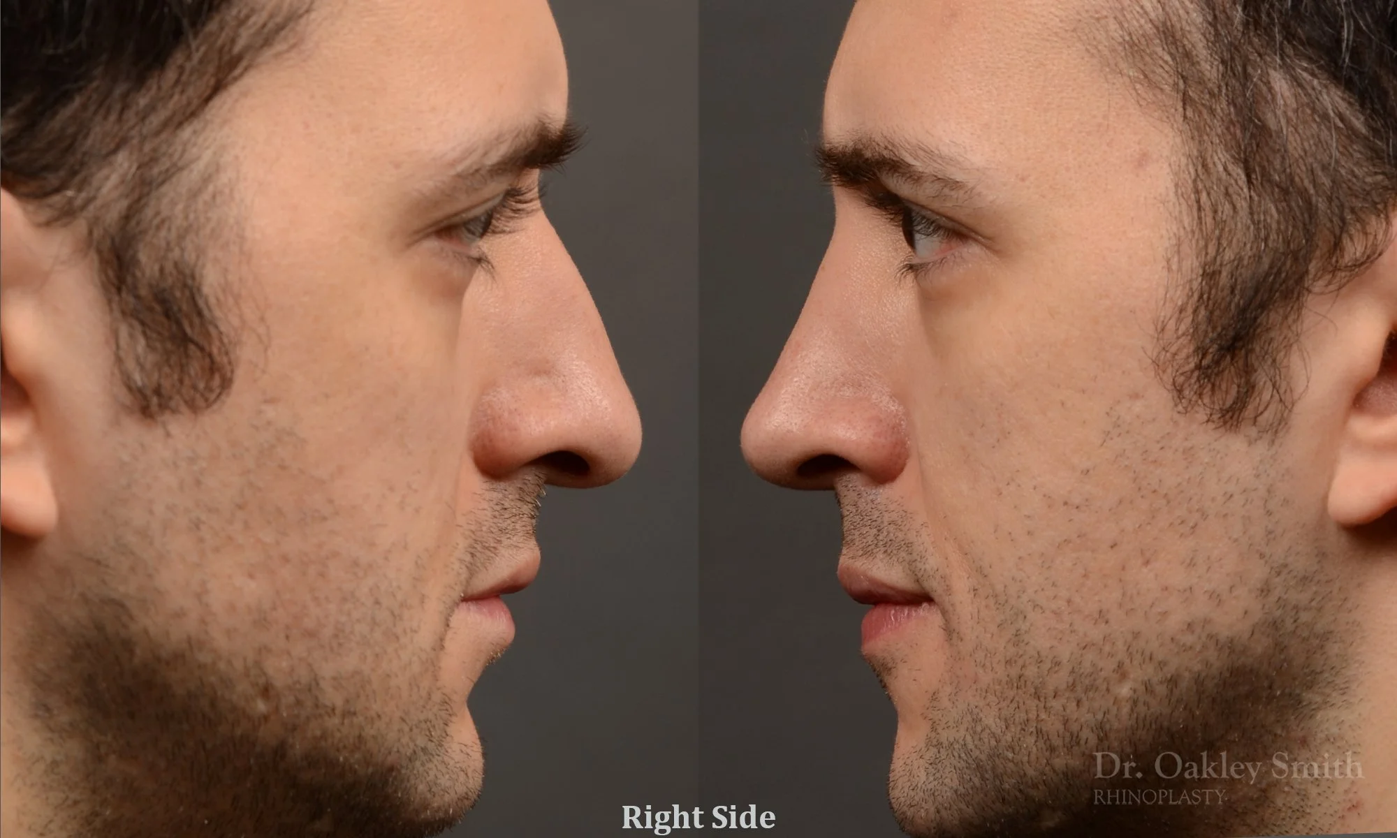 428C-male-rhinoplasty-dr-oakley-smith-toronto-top-surgeon-nose-job.jpg