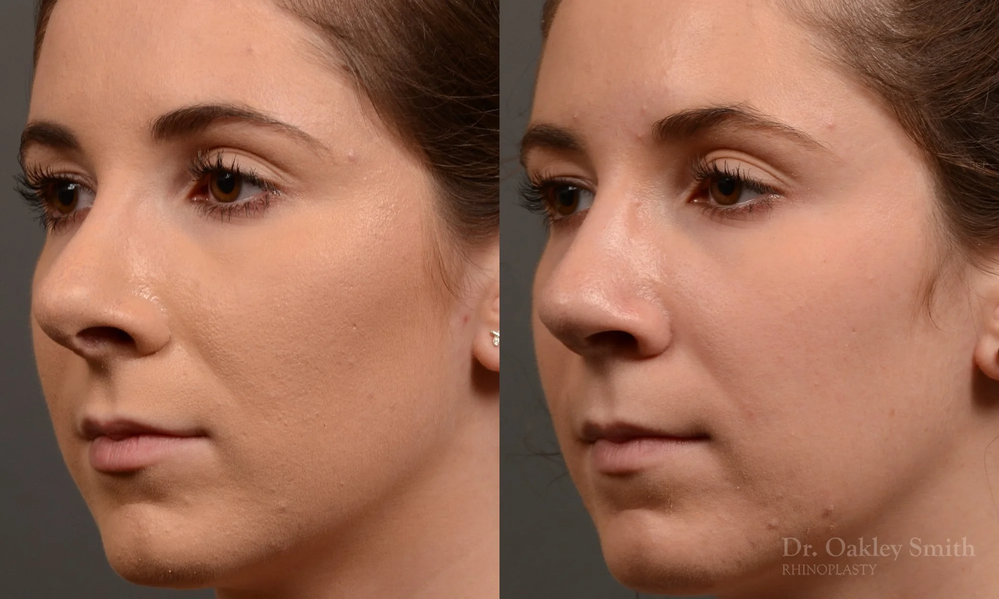 366D-rhinoplasty-dr-oakley-smith-toronto-nose-job.jpg