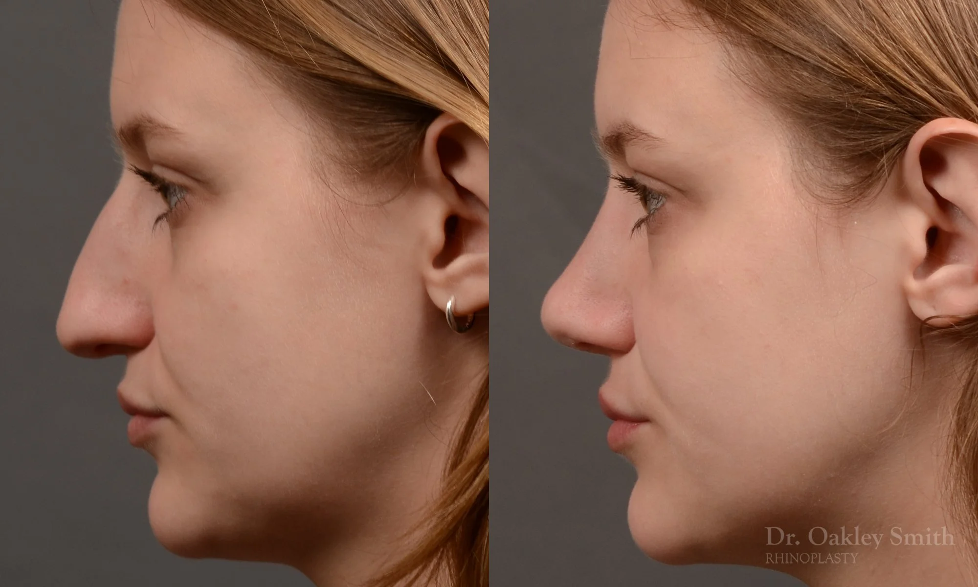 539E-rhinoplasty-dr-oakley-smith-toronto-nose-job.jpg