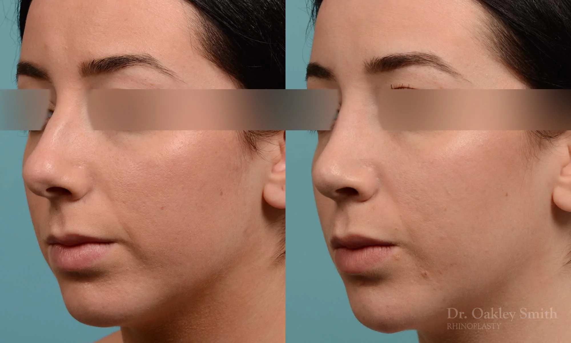 283D-rhinoplasty-dr-oakley-smith-toronto-nose-job (1).jpg