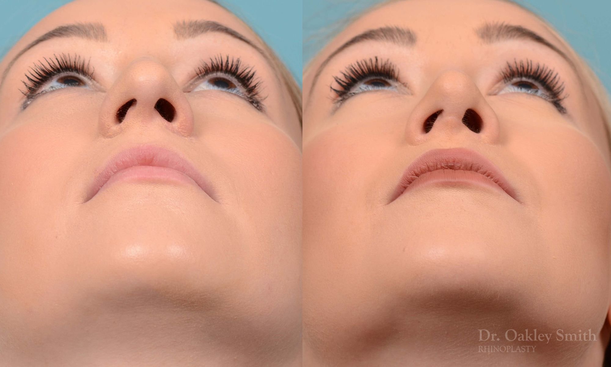 202F-watermark-nose-job-bump-rhinoplasty-toronto-nose-doctor-dr-oakley-smith-dr-oakley-smith-woman-female-droopy-raised-columellar-1.jpg