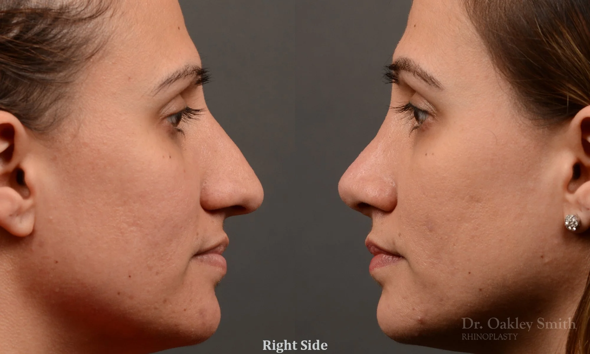 351: Female, Ethnic Rhinoplasty, Thick Skin, Dorsal Hump, Tip Refinement