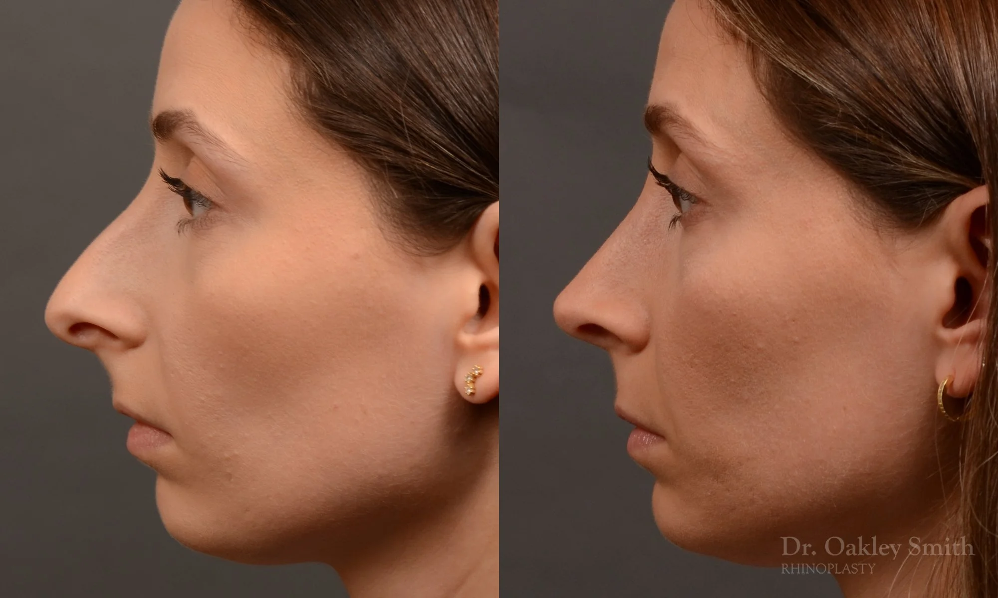 541E-rhinoplasty-dr-oakley-smith-toronto-nose-job.jpg