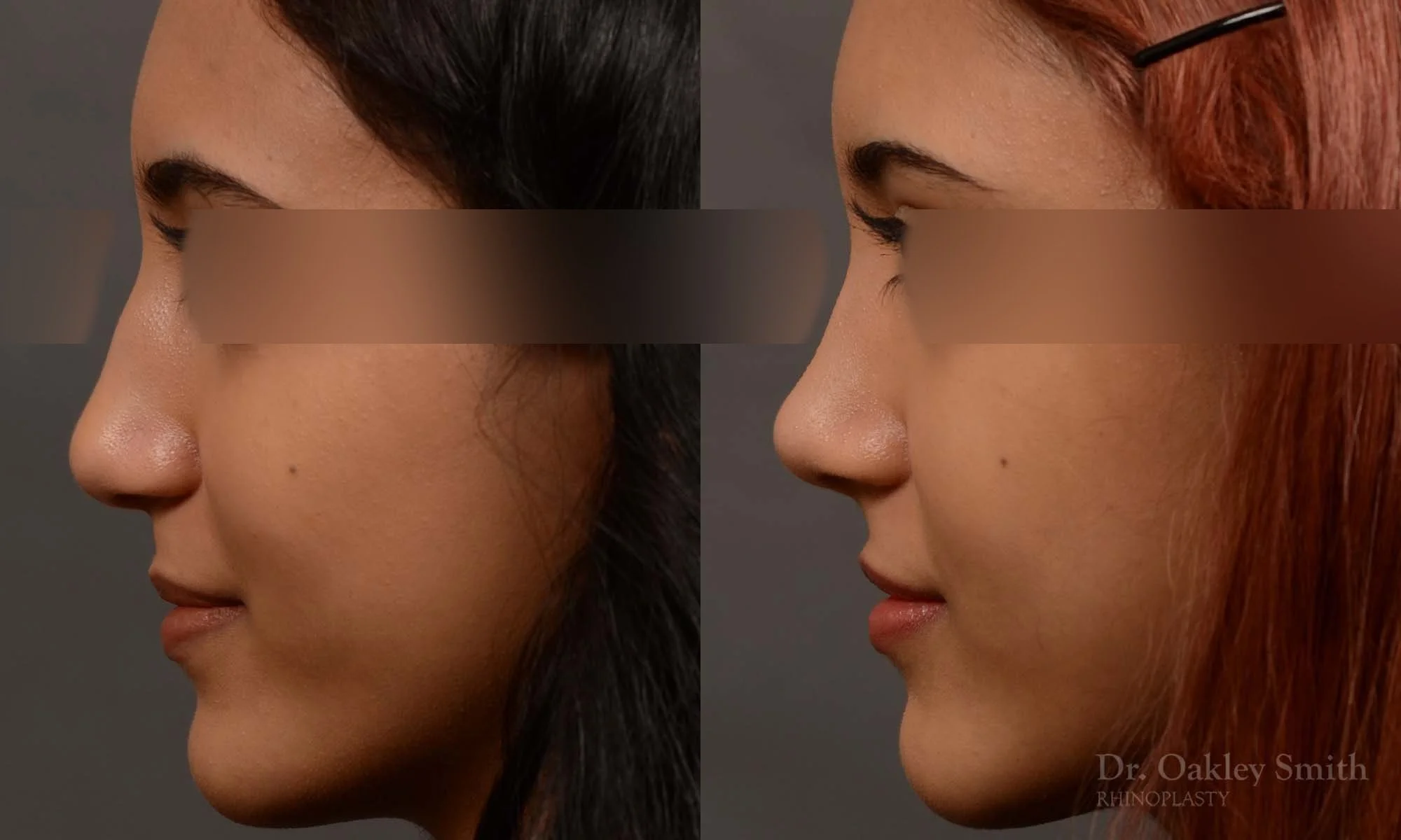 533E-rhinoplasty-dr-oakley-smith-toronto-top-surgeon-nose-job.jpg