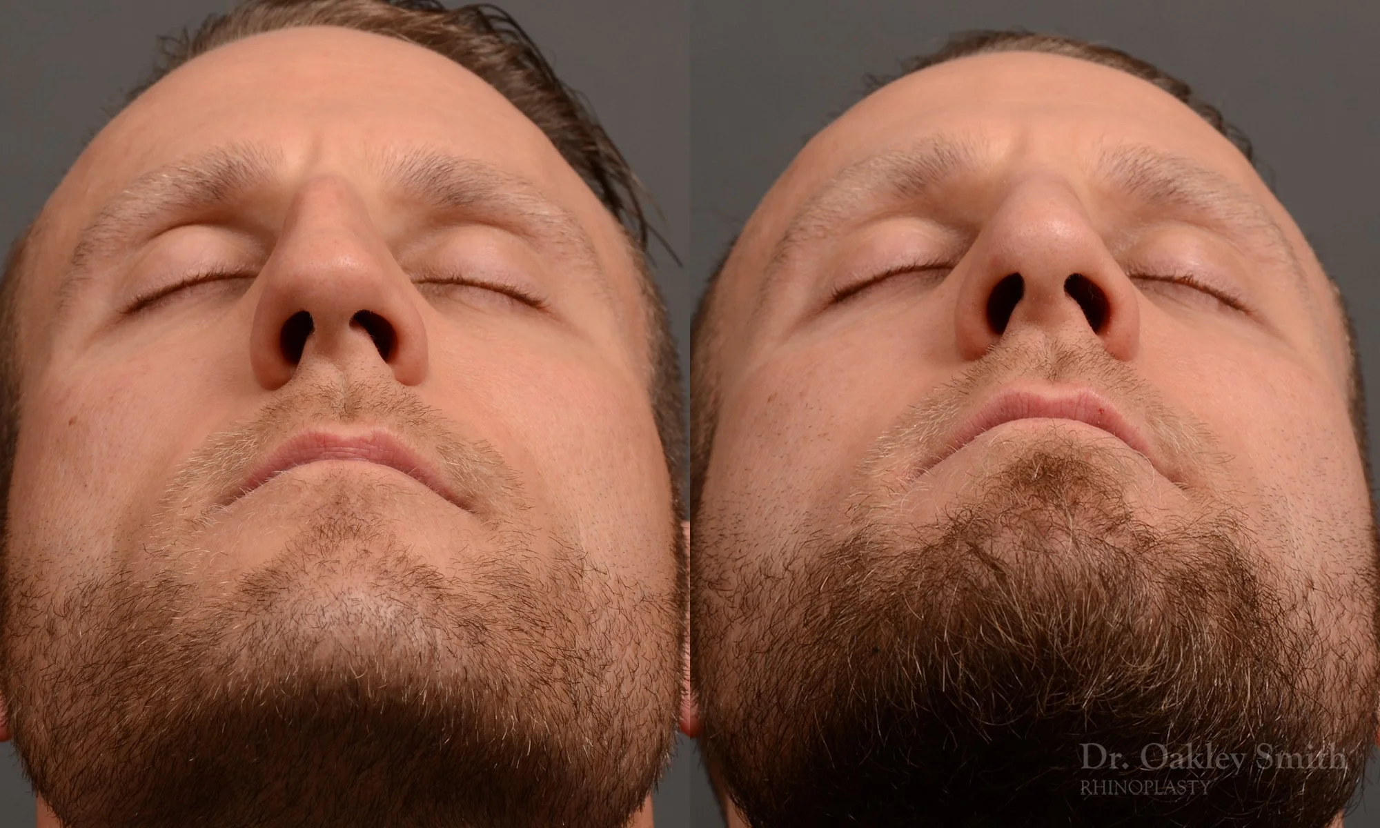367.1F-rhinoplasty-dr-oakley-smith-toronto-male-nose-job.jpg