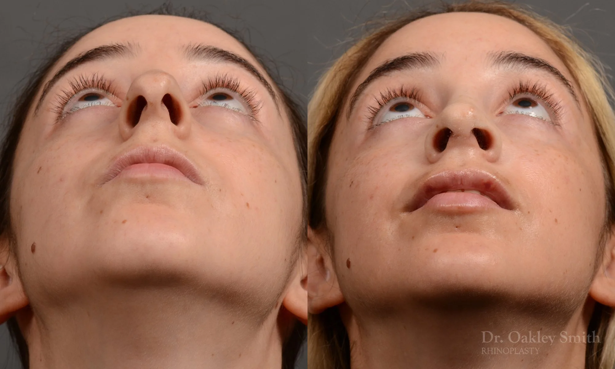286F-rhinoplasty-dr-oakley-smith-toronto-nose-job.jpg