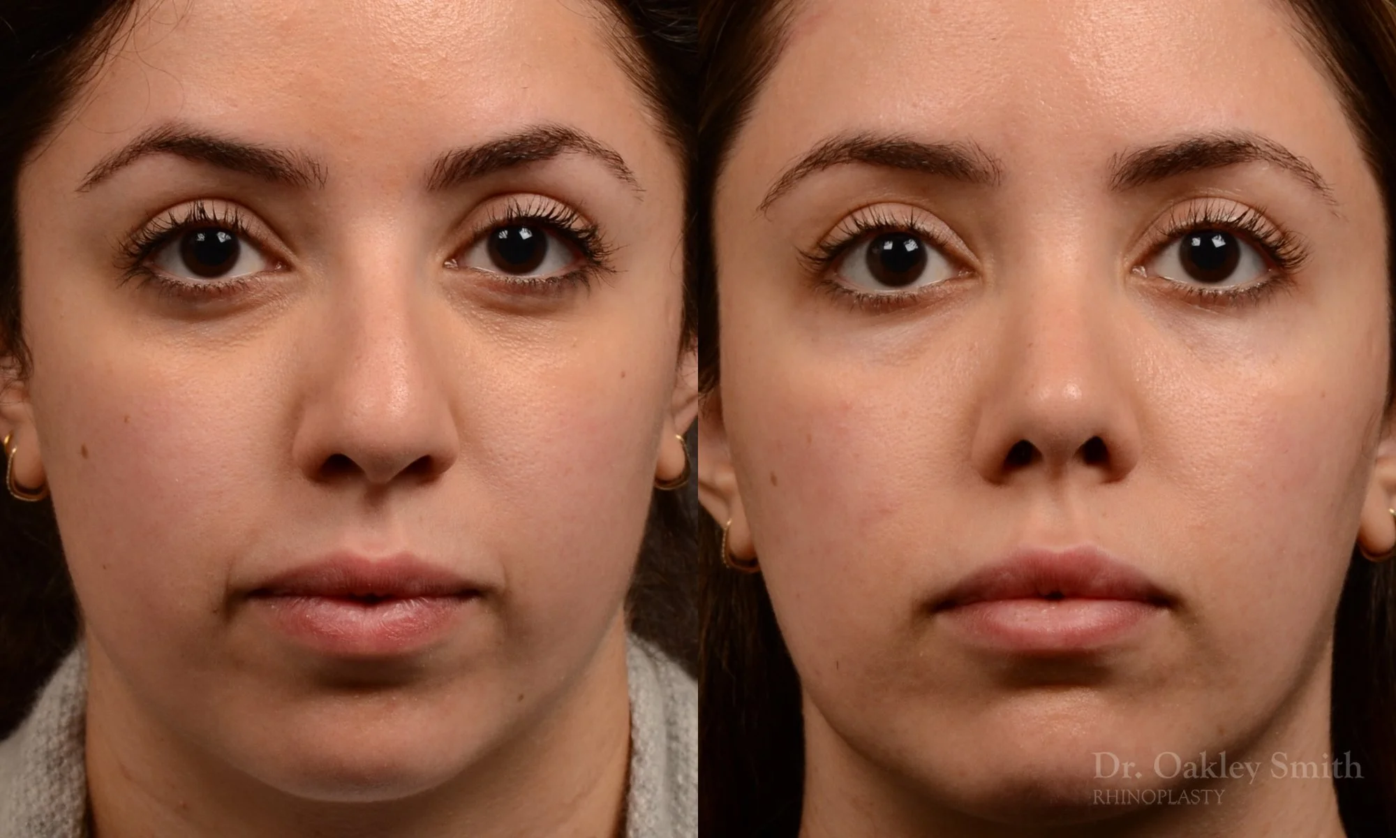 507A-rhinoplasty-dr-oakley-smith-toronto-top-surgeon-nose-job.jpg