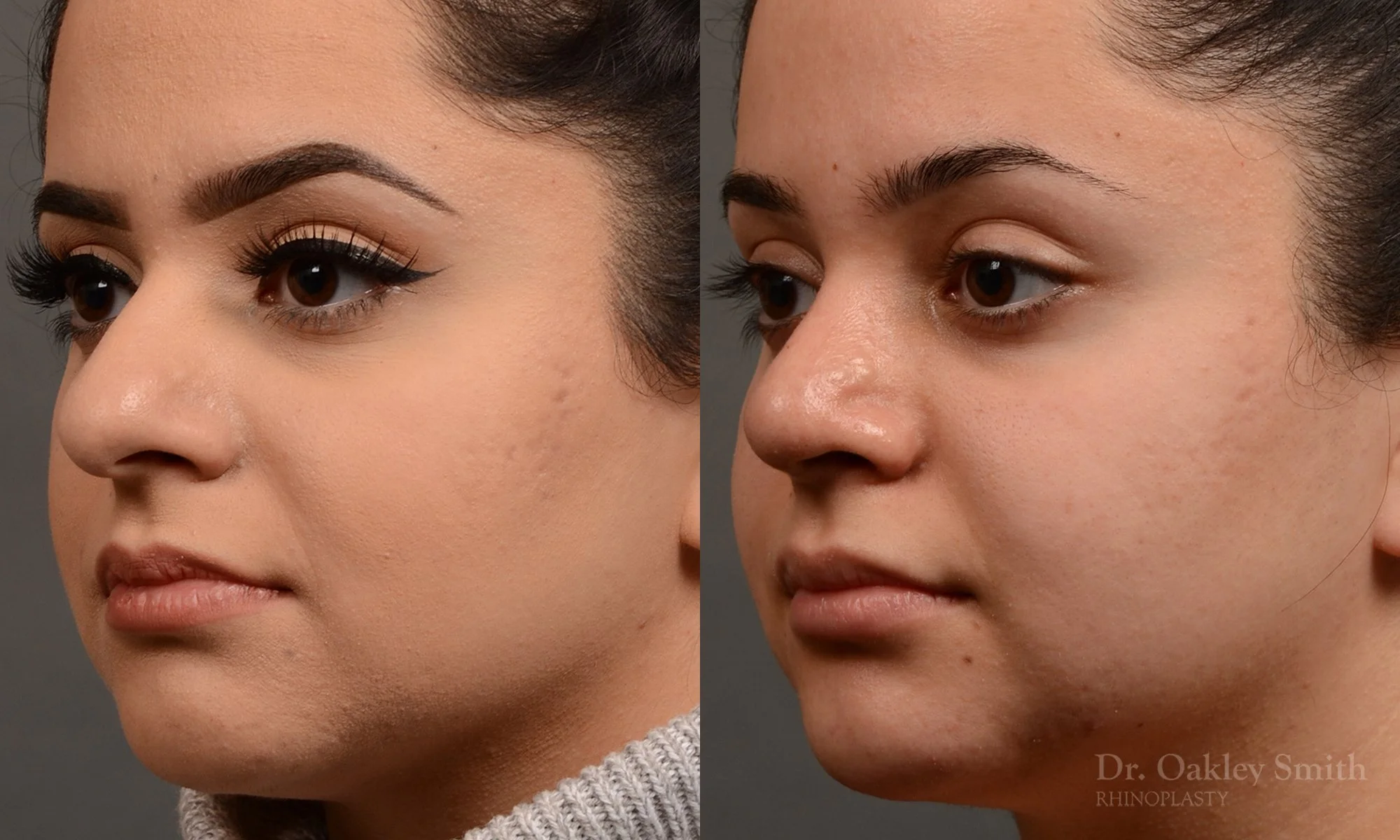 304D-rhinoplasty-dr-oakley-smith-toronto-nose-job.jpg