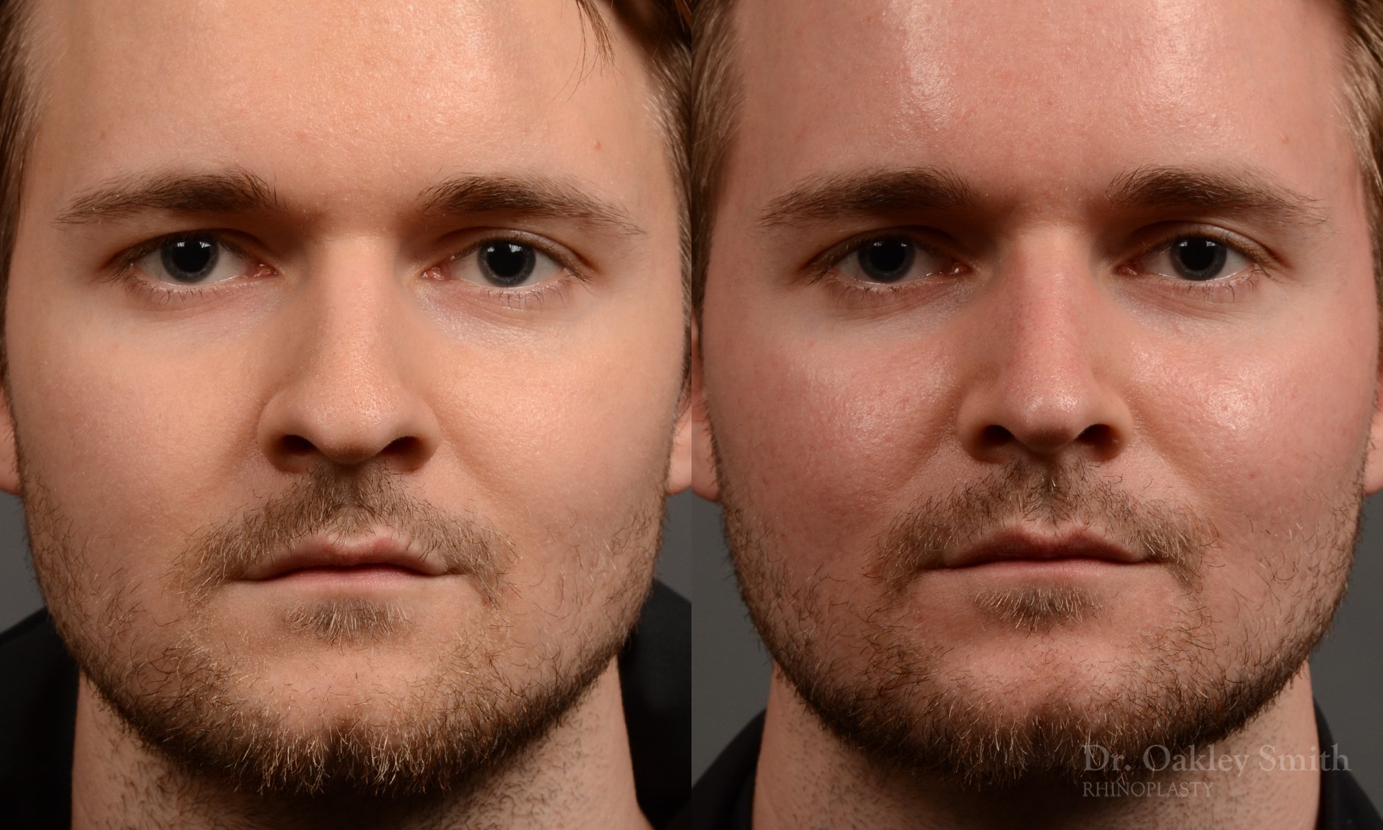401A-expert-rhinoplasty-surgeon-rhinoplasty-dr-oakley-smith-toronto-nose-job-surgery.jpg