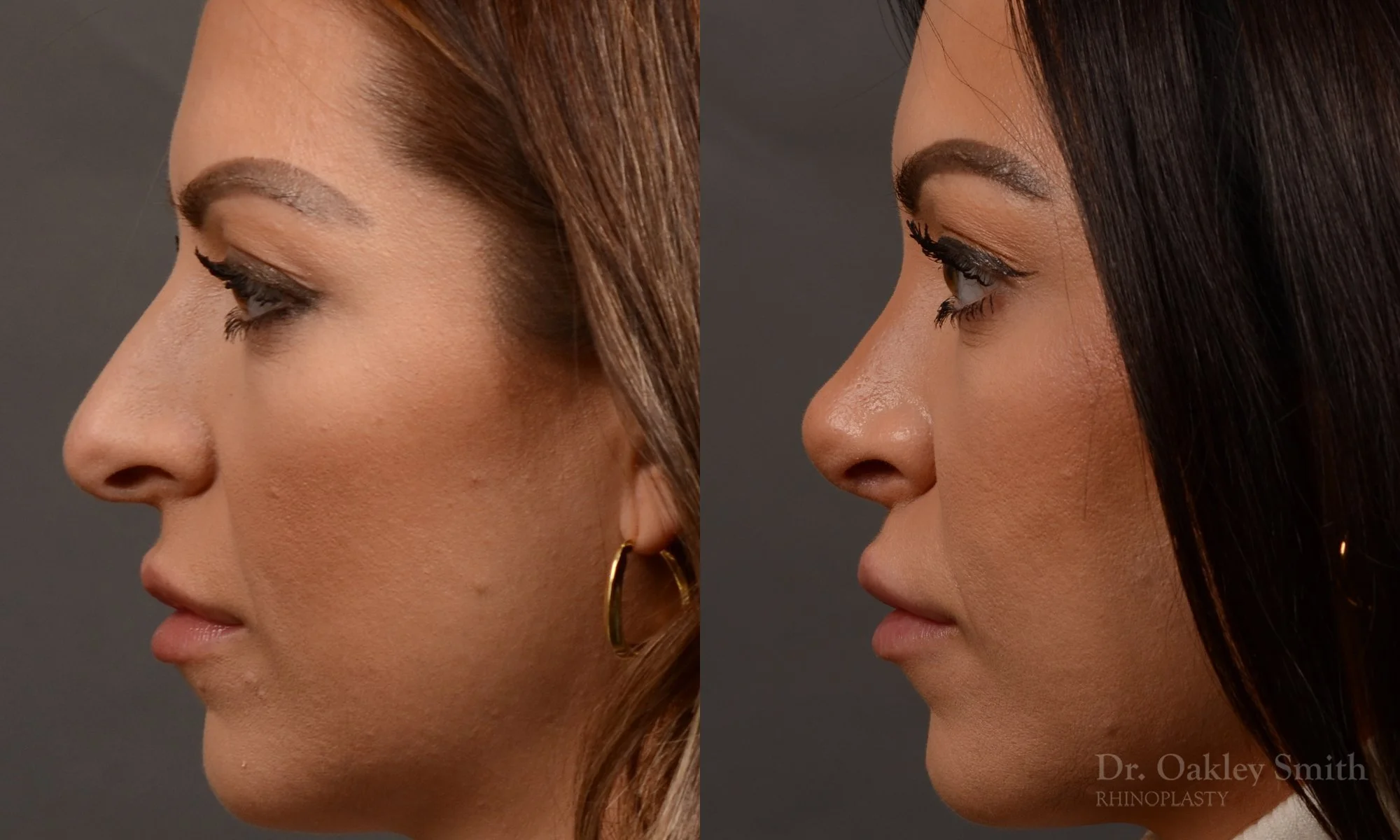 524E-rhinoplasty-dr-oakley-smith-toronto-top-surgeon-nose-job.jpg
